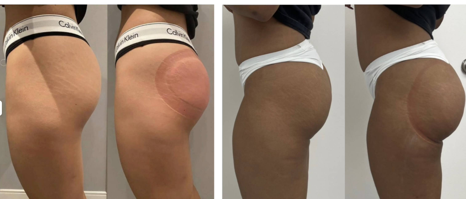 Before and after results