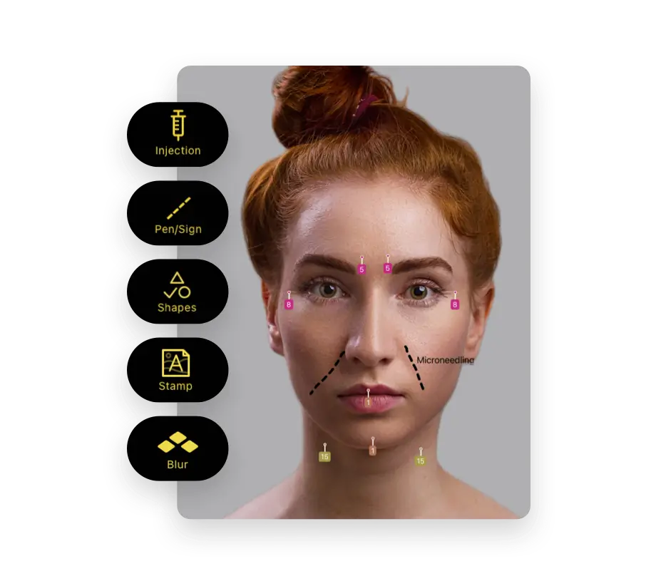 Clinical photo with injection sites and treatment areas marked using annotation tools