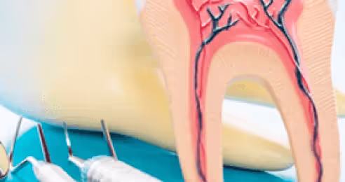 Endo Treatment 