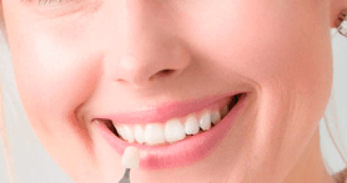 Porcelain Veneers
