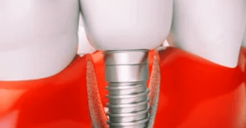 same-day dental implants in staten island