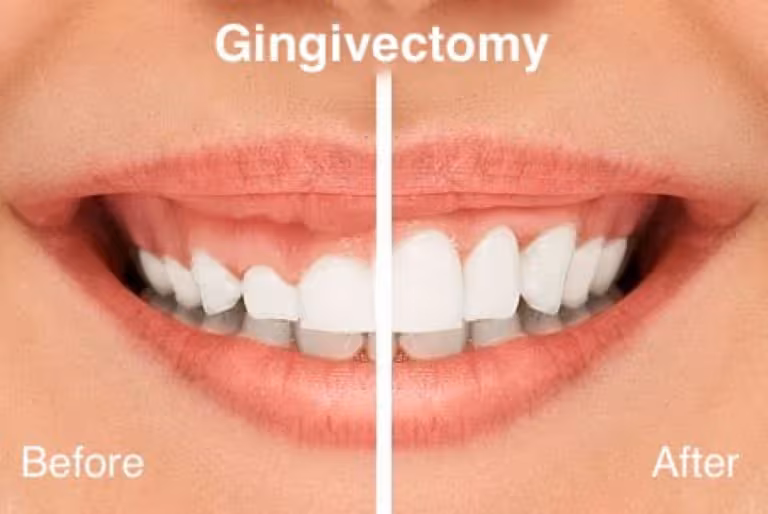 Gum Surgery Aftercare: What to Do After a Gingivectomy at Sola Dental Spa