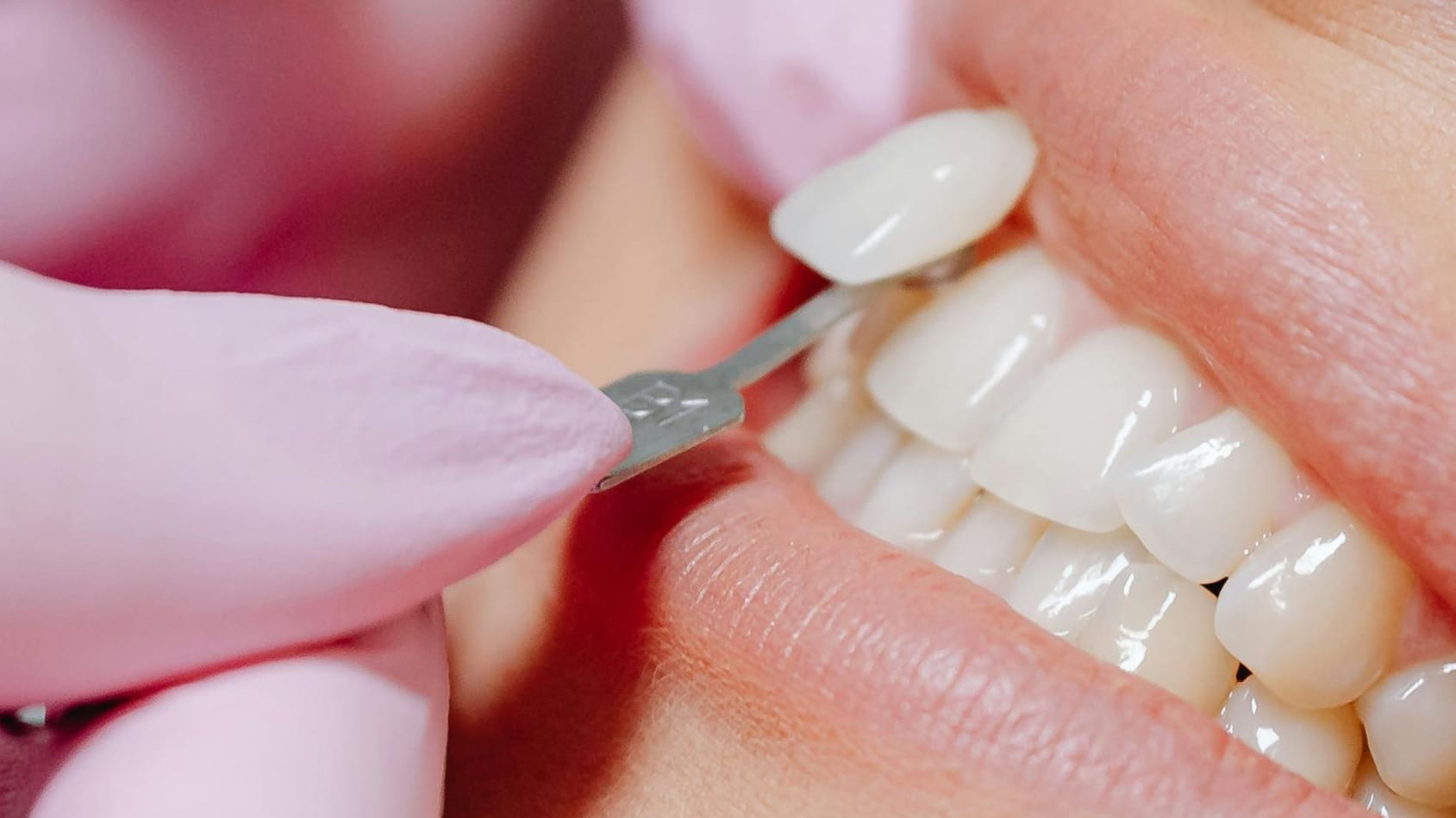 Dental veneer placement