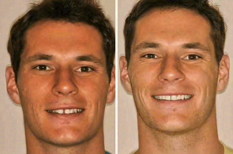 Before and after: porcelain veneers and whitening case at Sola Dental Spa