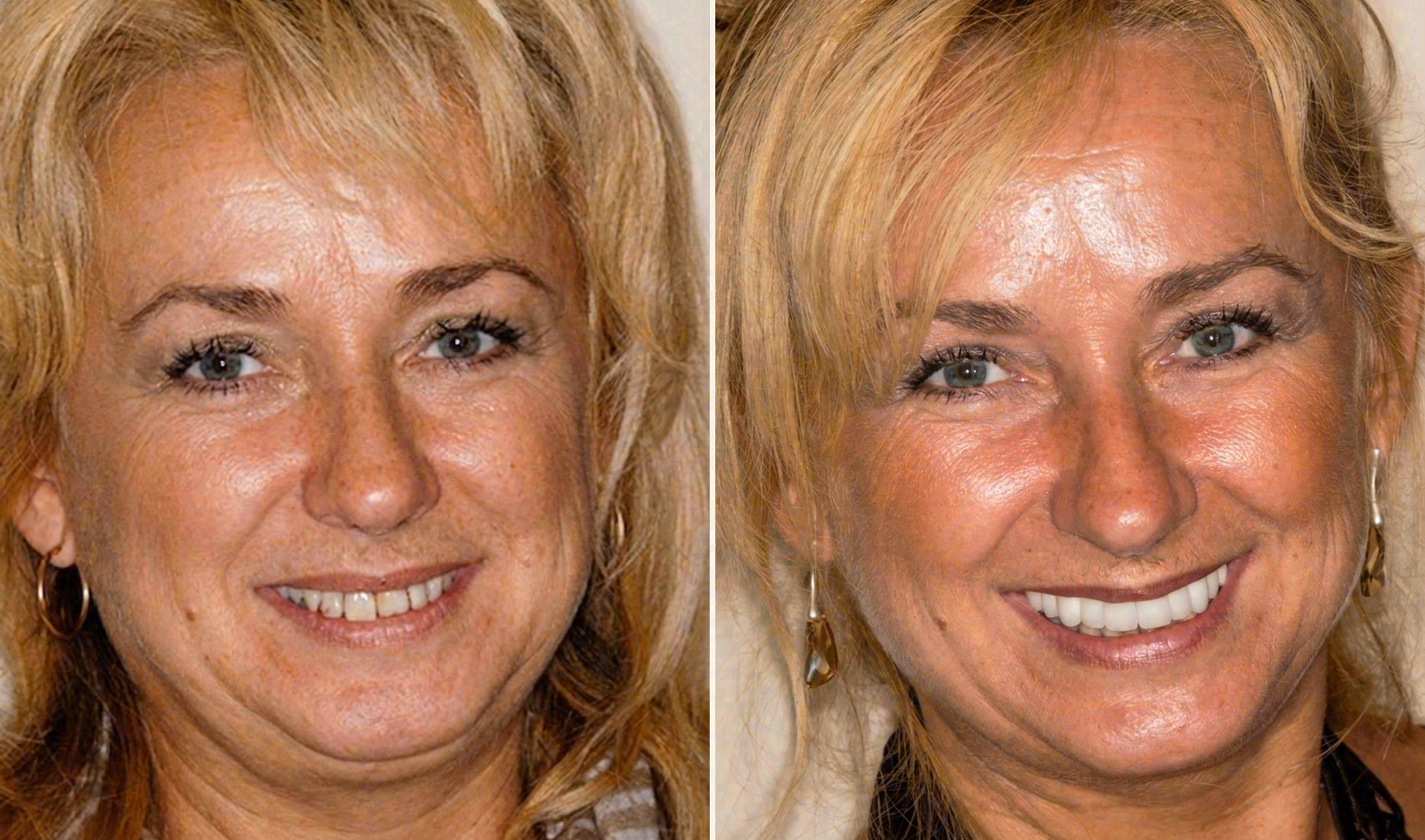 Before and after: porcelain veneers case at Sola Dental Spa