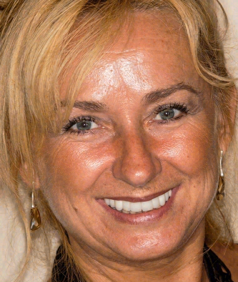 After porcelain veneers at Sola Dental Spa