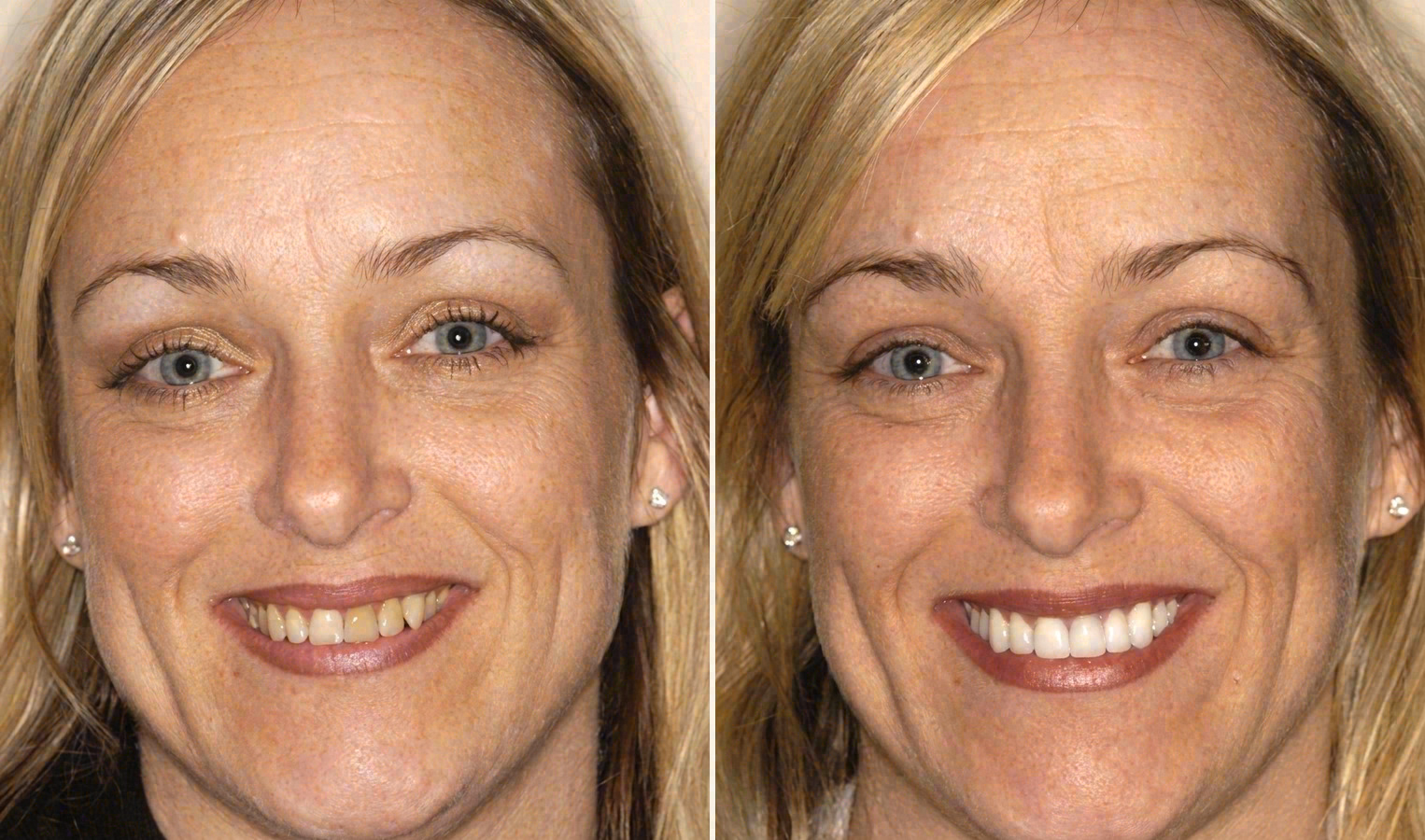 Before and after: porcelain veneers case at Sola Dental Spa