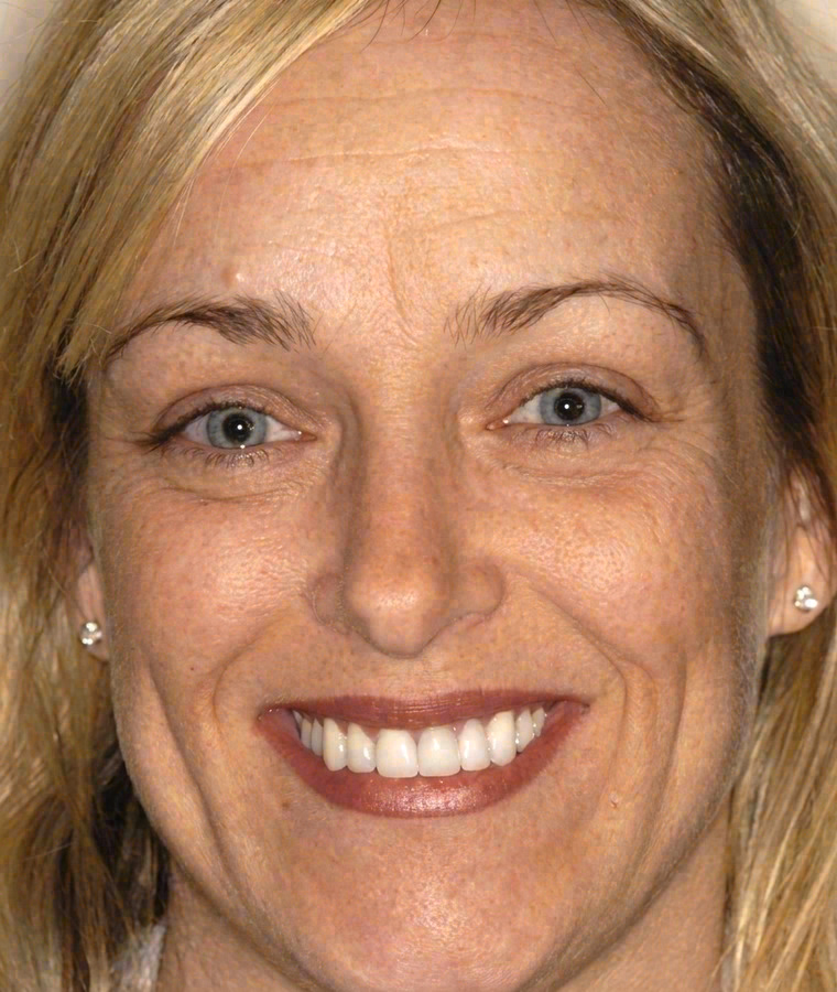 After porcelain veneers at Sola Dental Spa