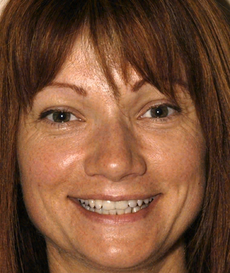 Before porcelain veneers at Sola Dental Spa
