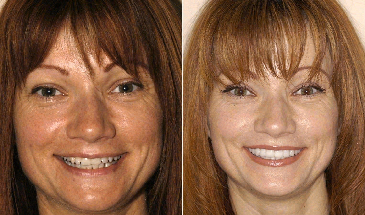 Before and after: porcelain veneers case at Sola Dental Spa