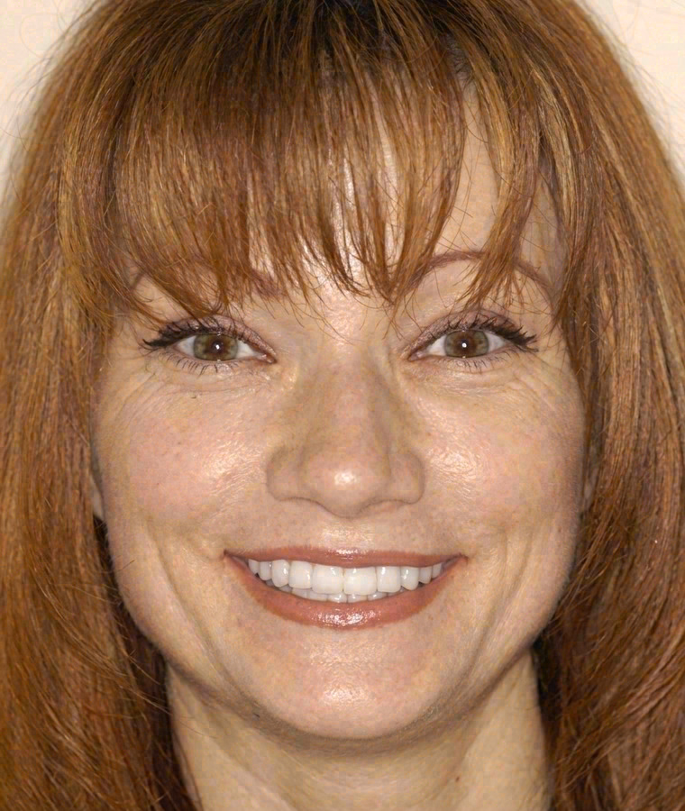 After porcelain veneers at Sola Dental Spa