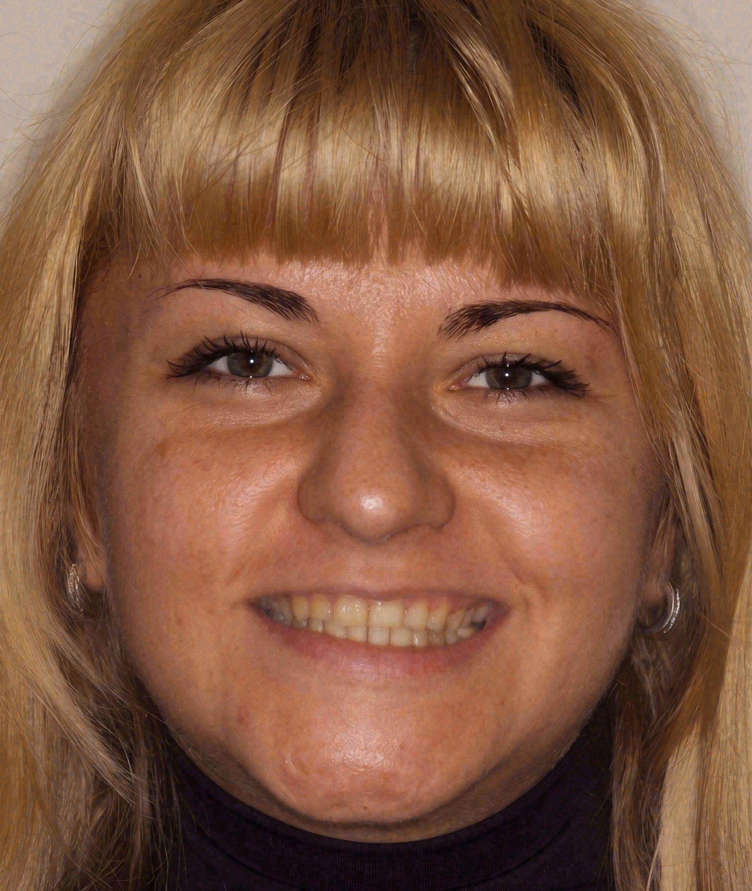 Before porcelain veneers at Sola Dental Spa