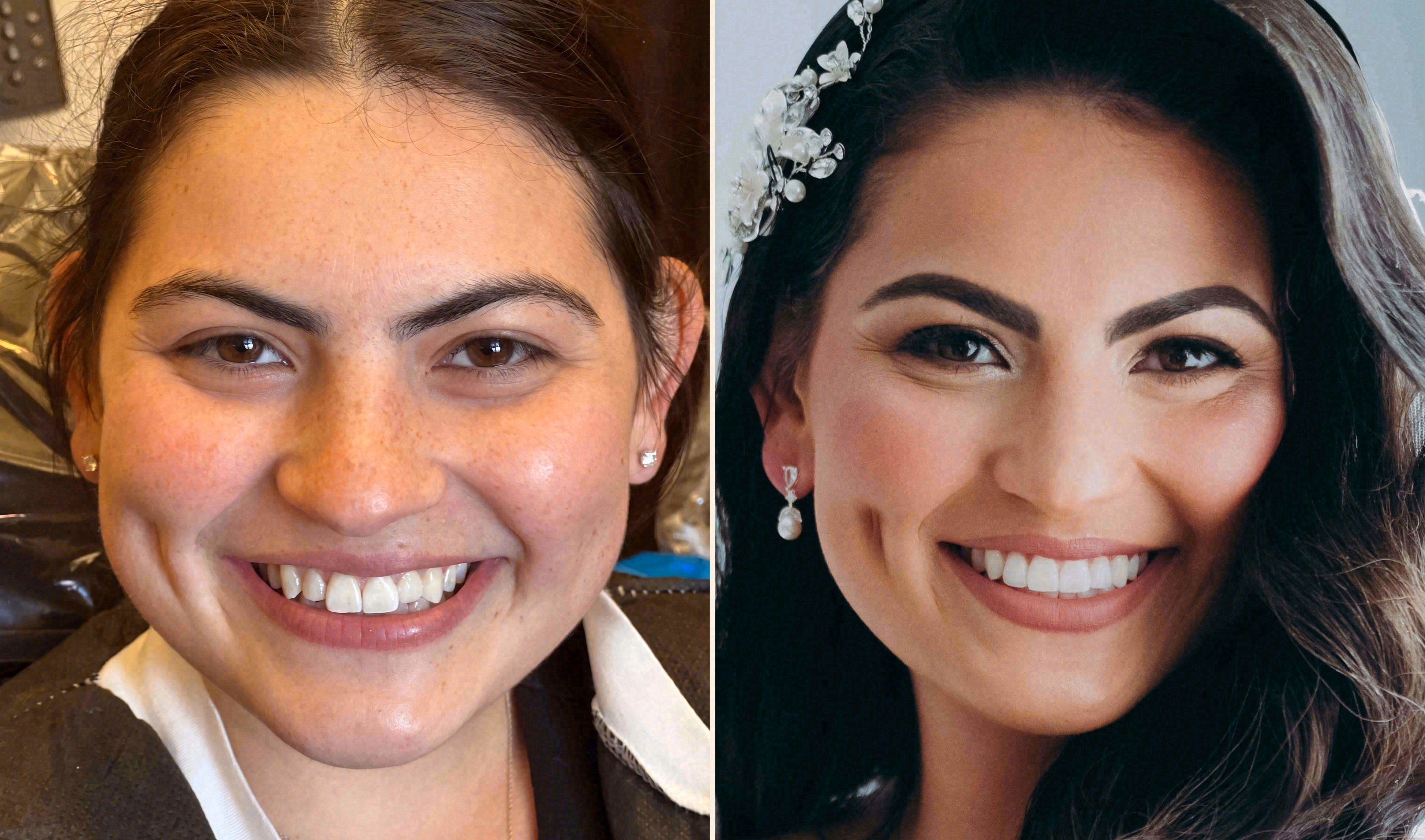 Before and after: porcelain veneers case at Sola Dental Spa