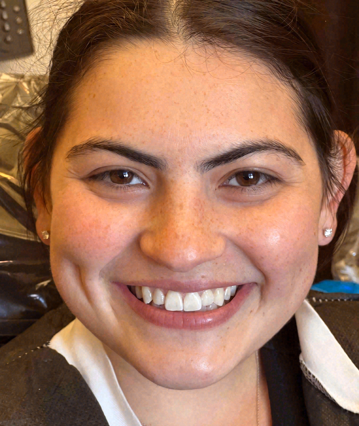 Before porcelain veneers at Sola Dental Spa