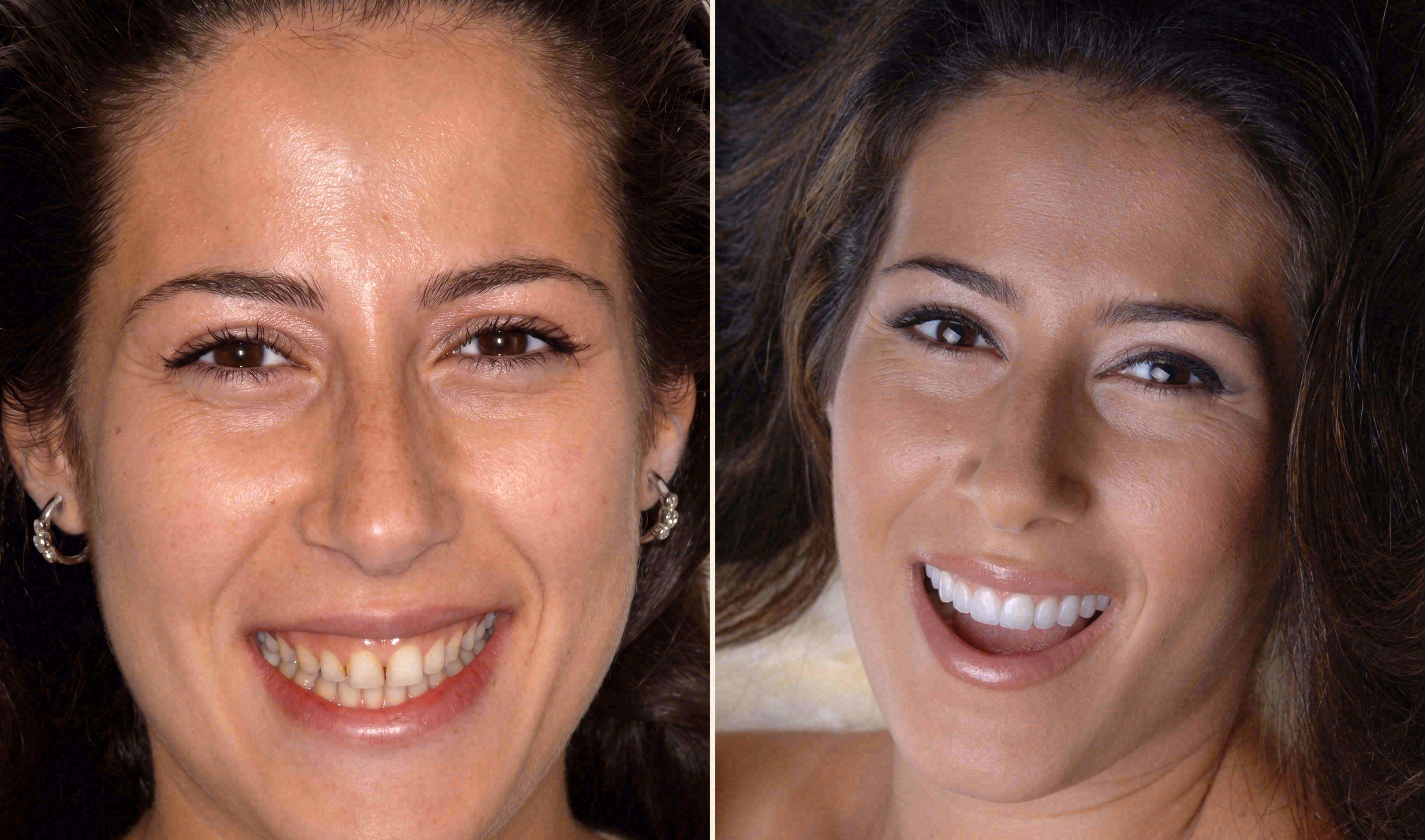 Before and after: porcelain veneers case at Sola Dental Spa