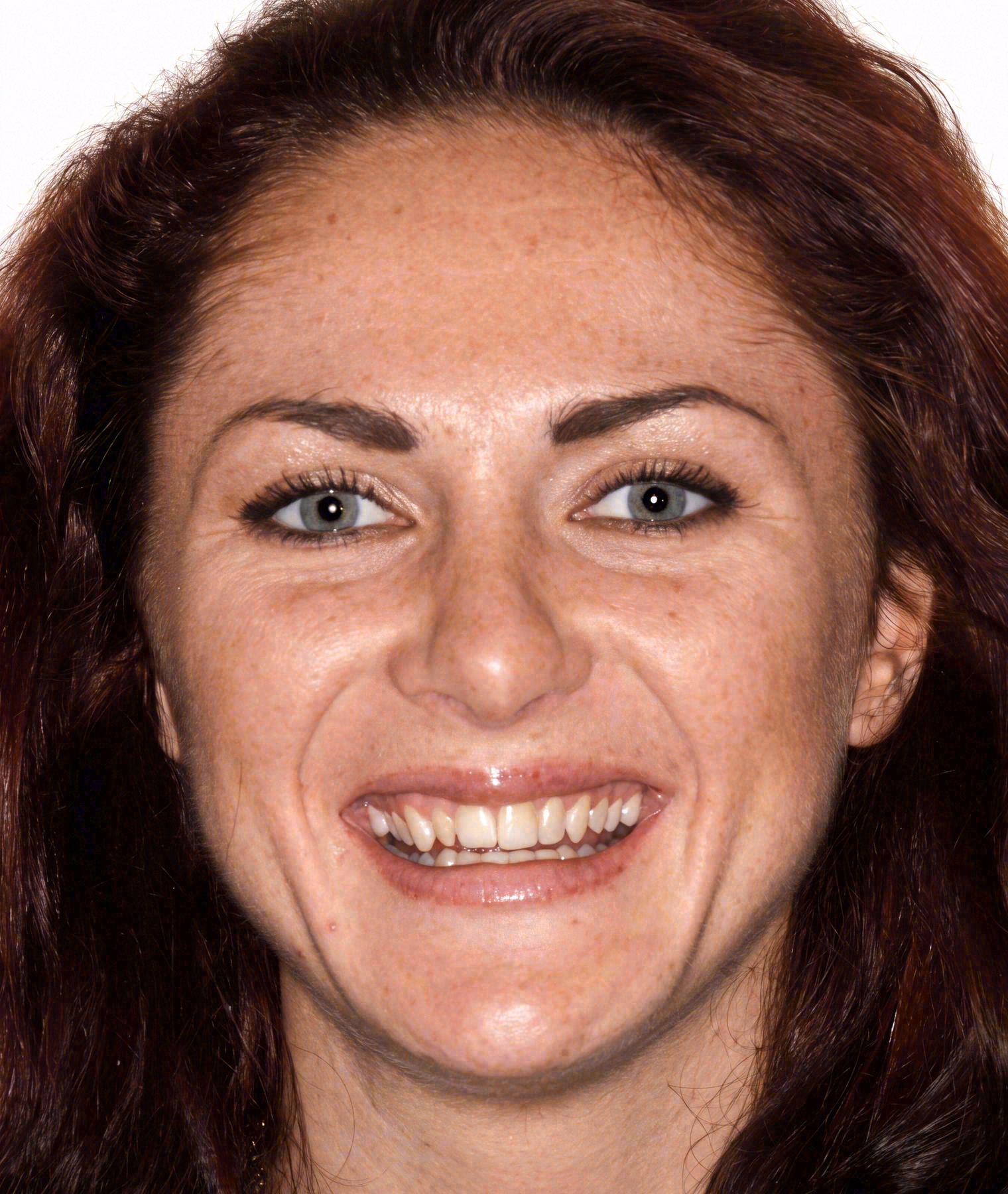 Before porcelain veneers at Sola Dental Spa