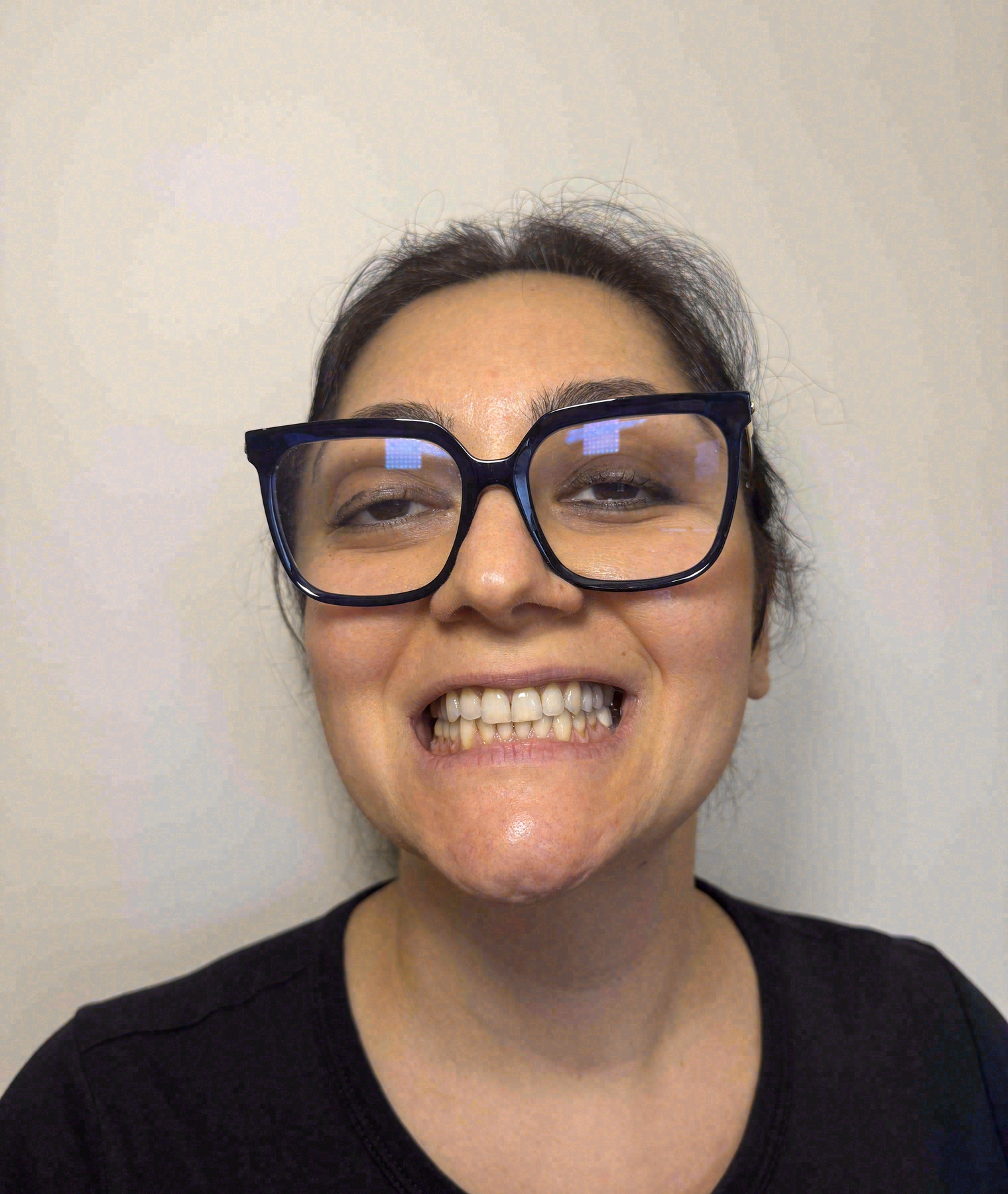 Before porcelain veneers at Sola Dental Spa