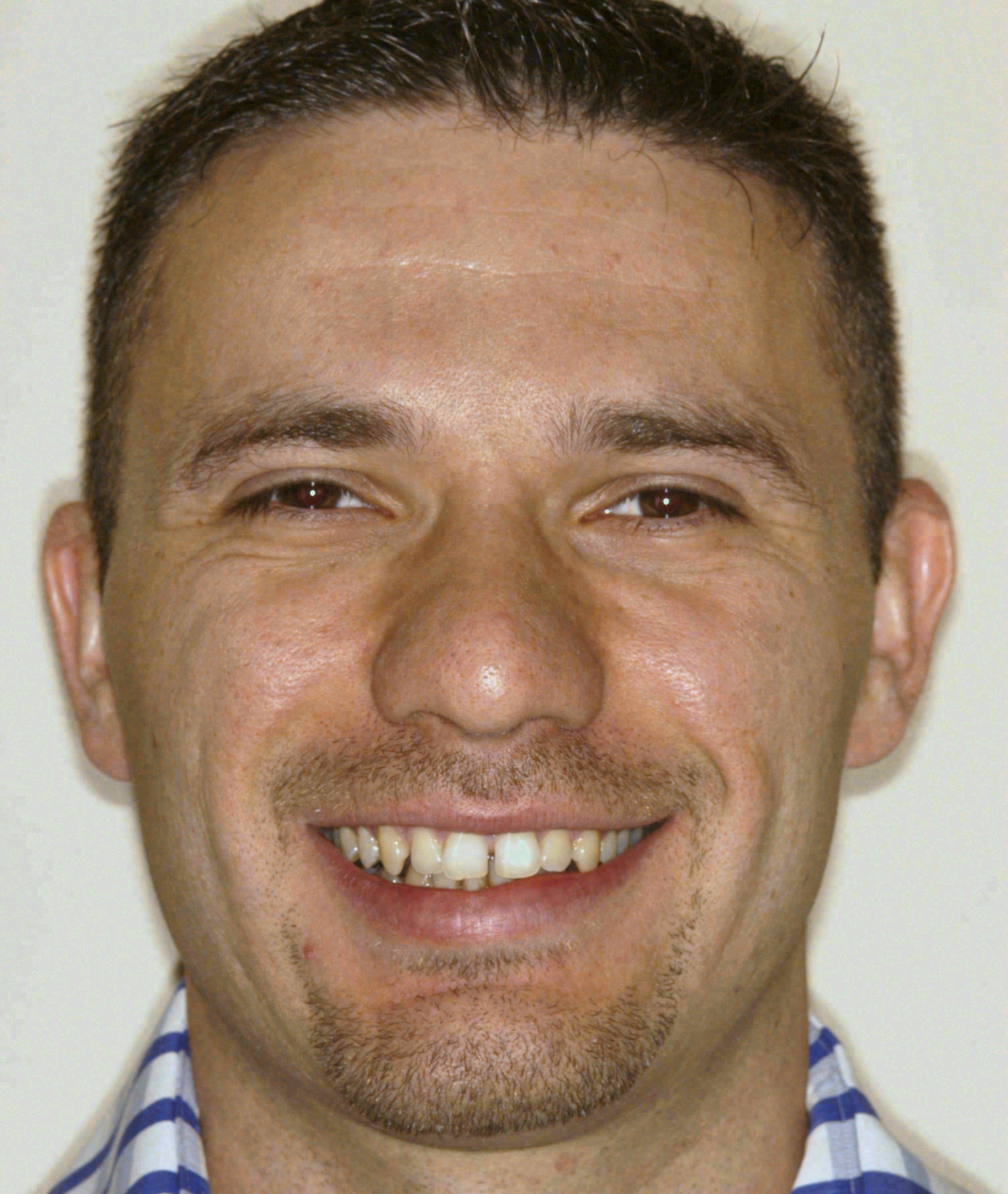 Before porcelain veneers at Sola Dental Spa