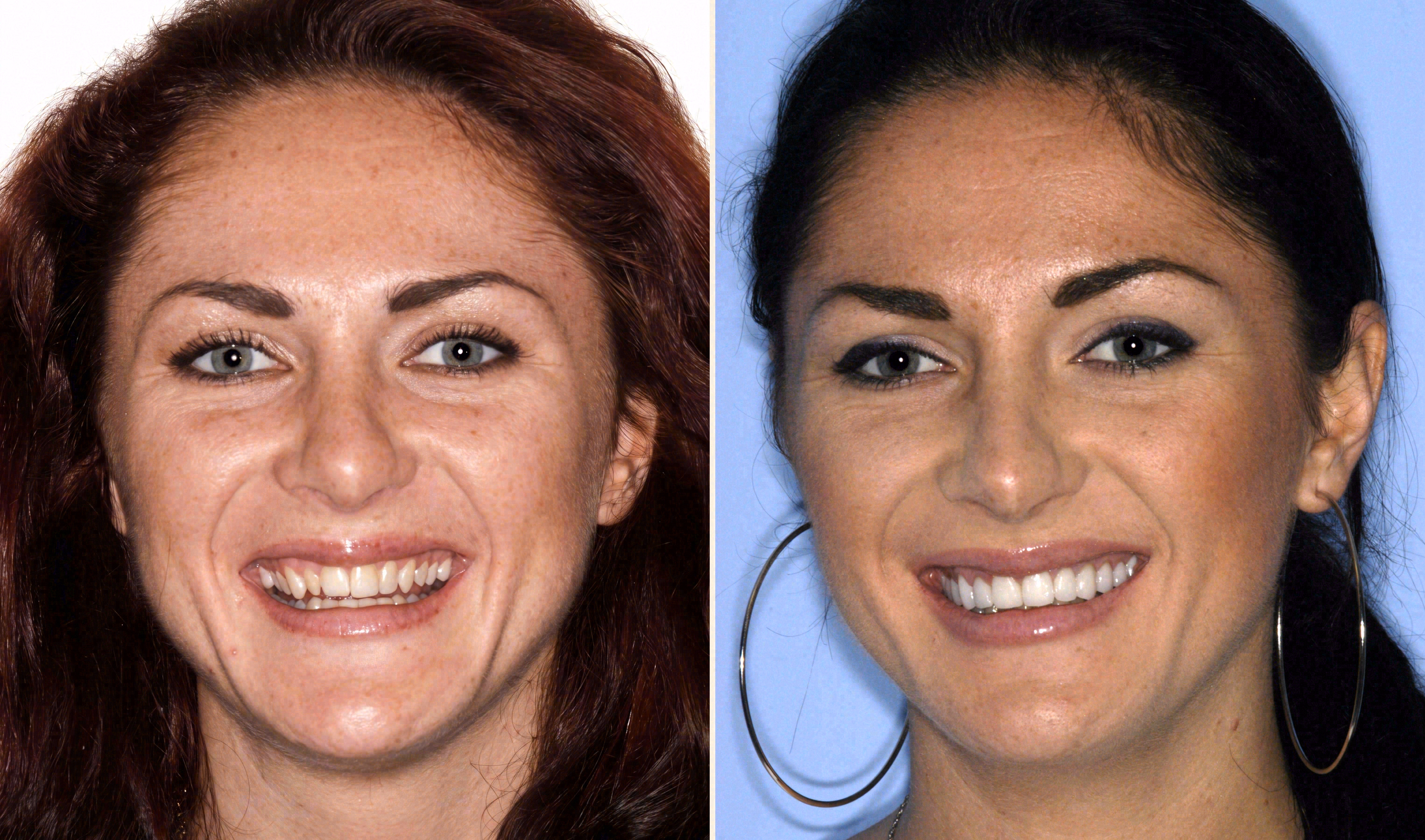 Before and after: porcelain veneers case at Sola Dental Spa