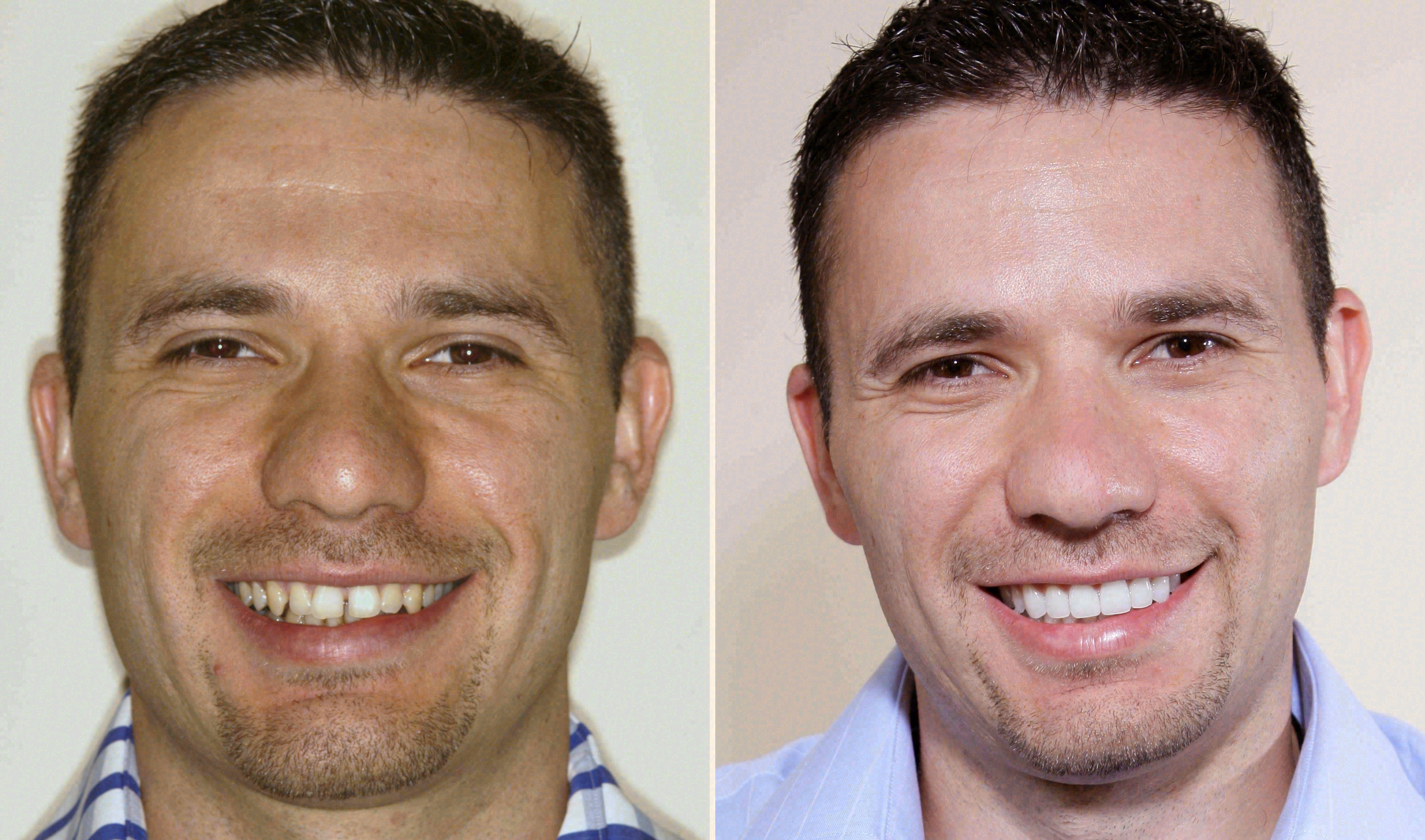 Before and after: porcelain veneers case at Sola Dental Spa