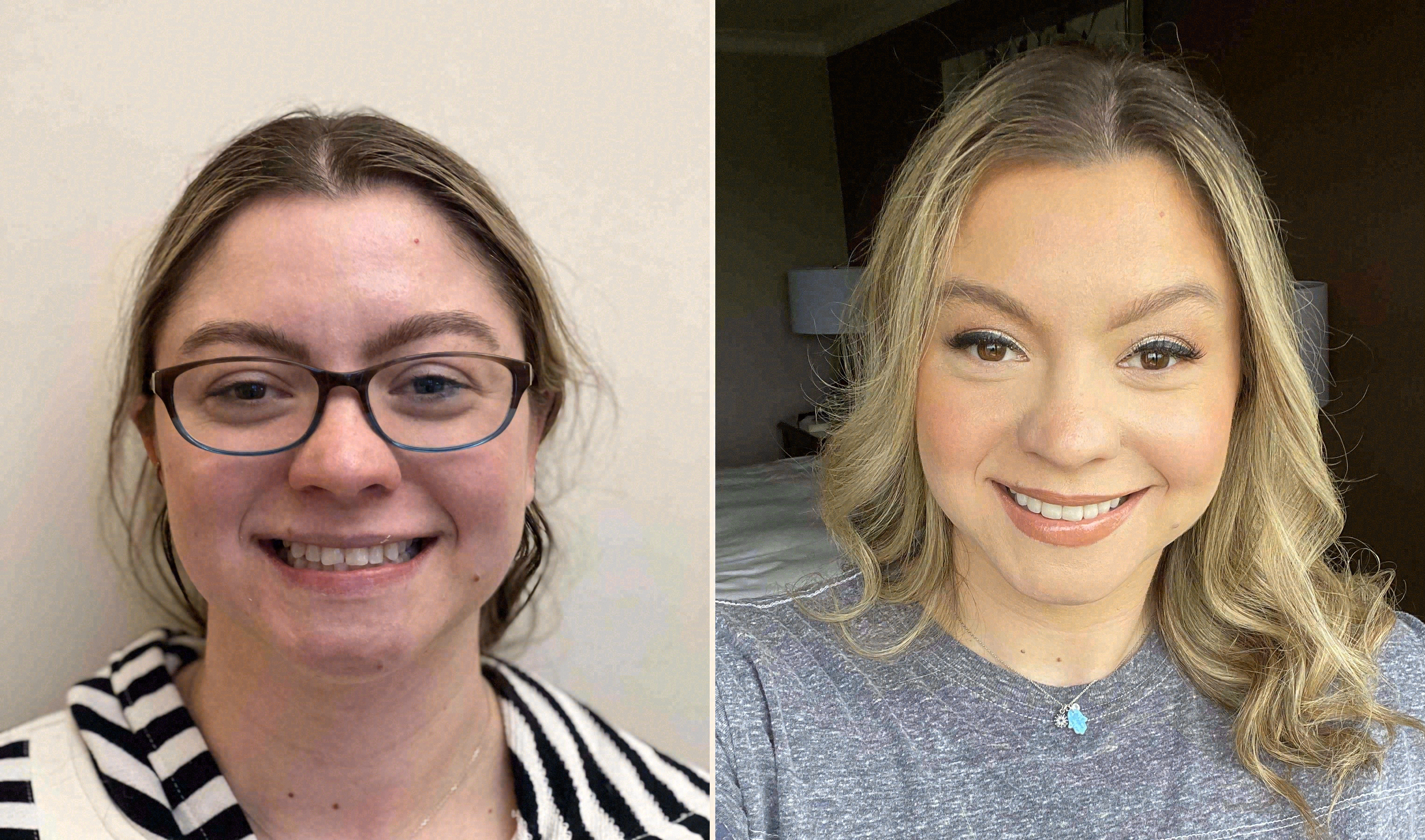 Before and after: porcelain veneers case at Sola Dental Spa