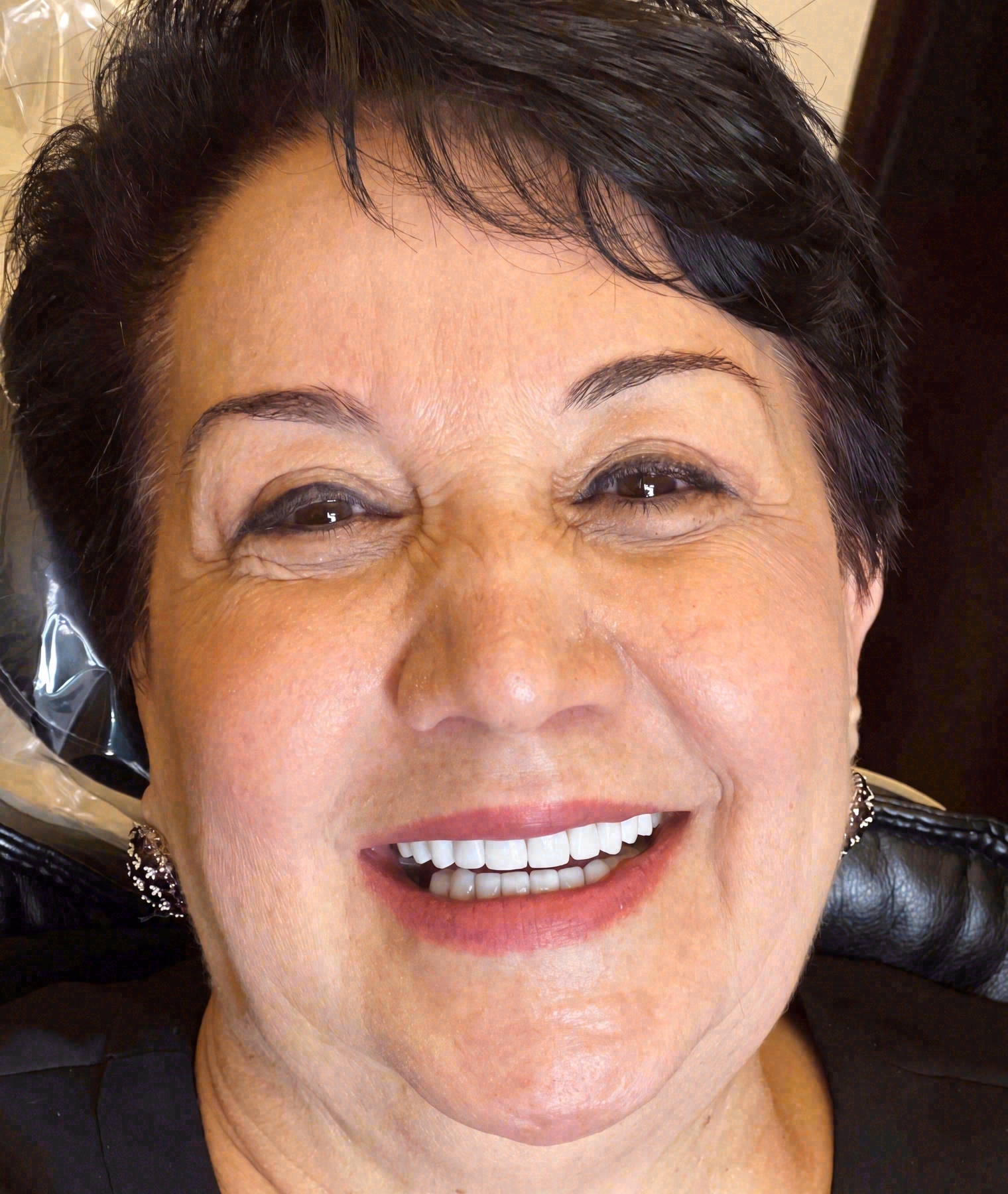 After porcelain veneers at Sola Dental Spa