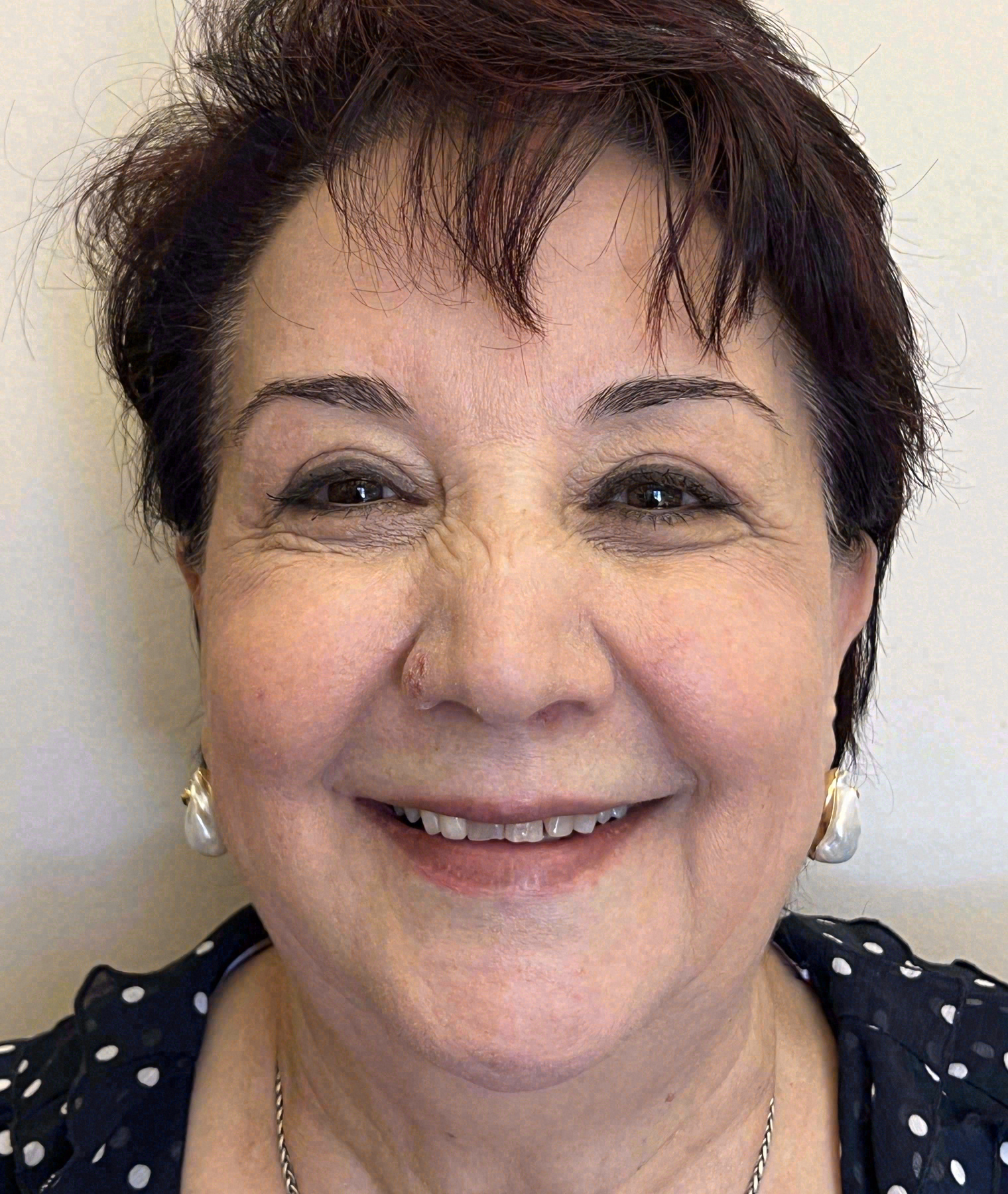 Before porcelain veneers at Sola Dental Spa