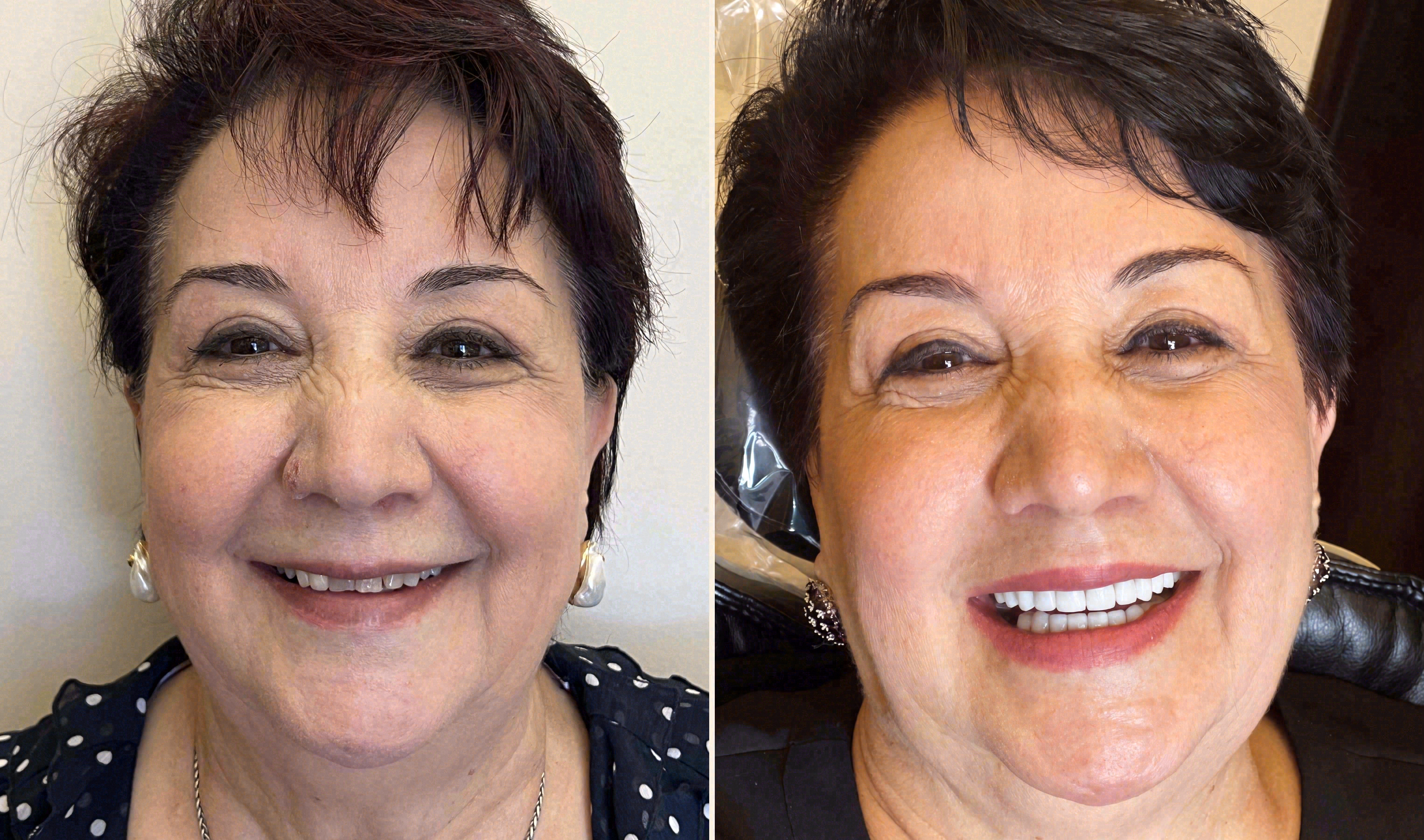 Before and after: porcelain veneers case at Sola Dental Spa