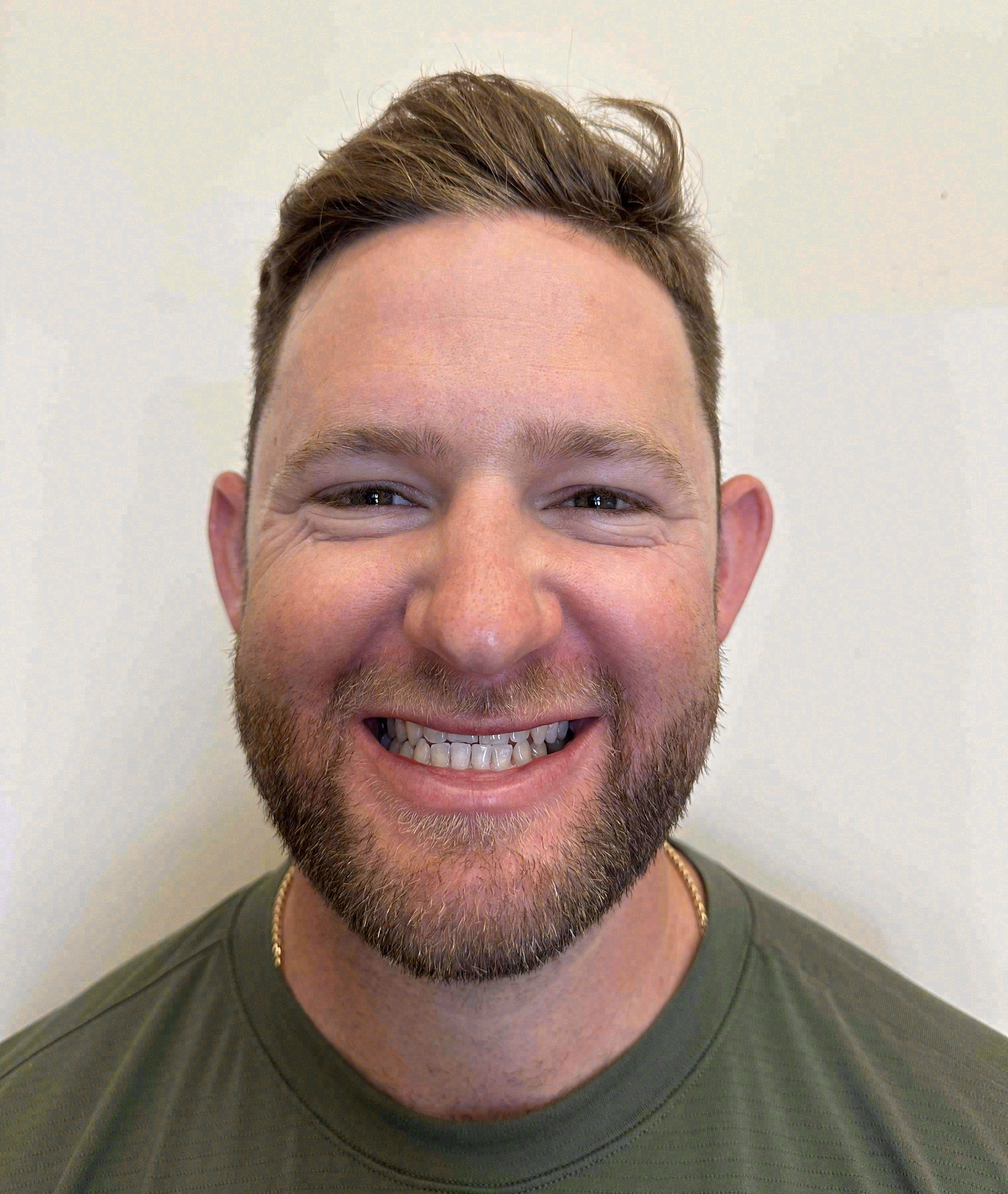 Before porcelain veneers at Sola Dental Spa