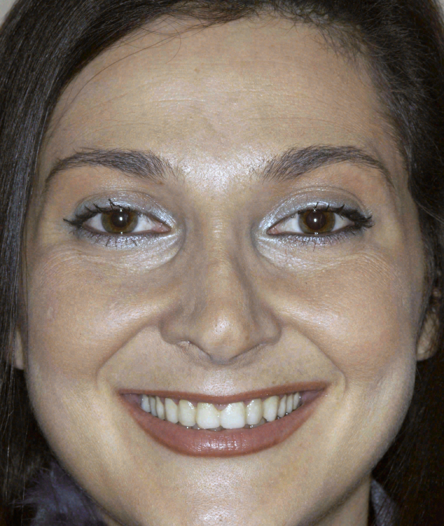 Before porcelain veneers at Sola Dental Spa
