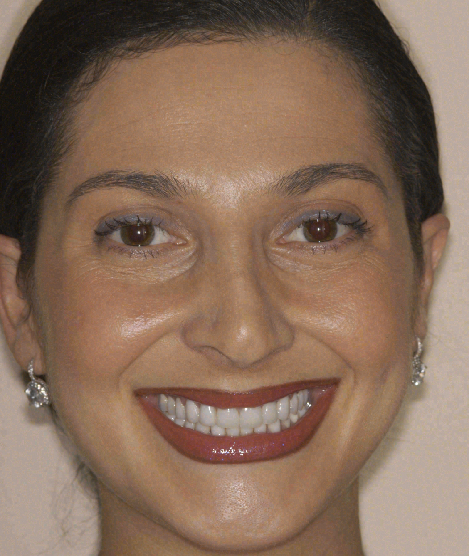 After porcelain veneers at Sola Dental Spa