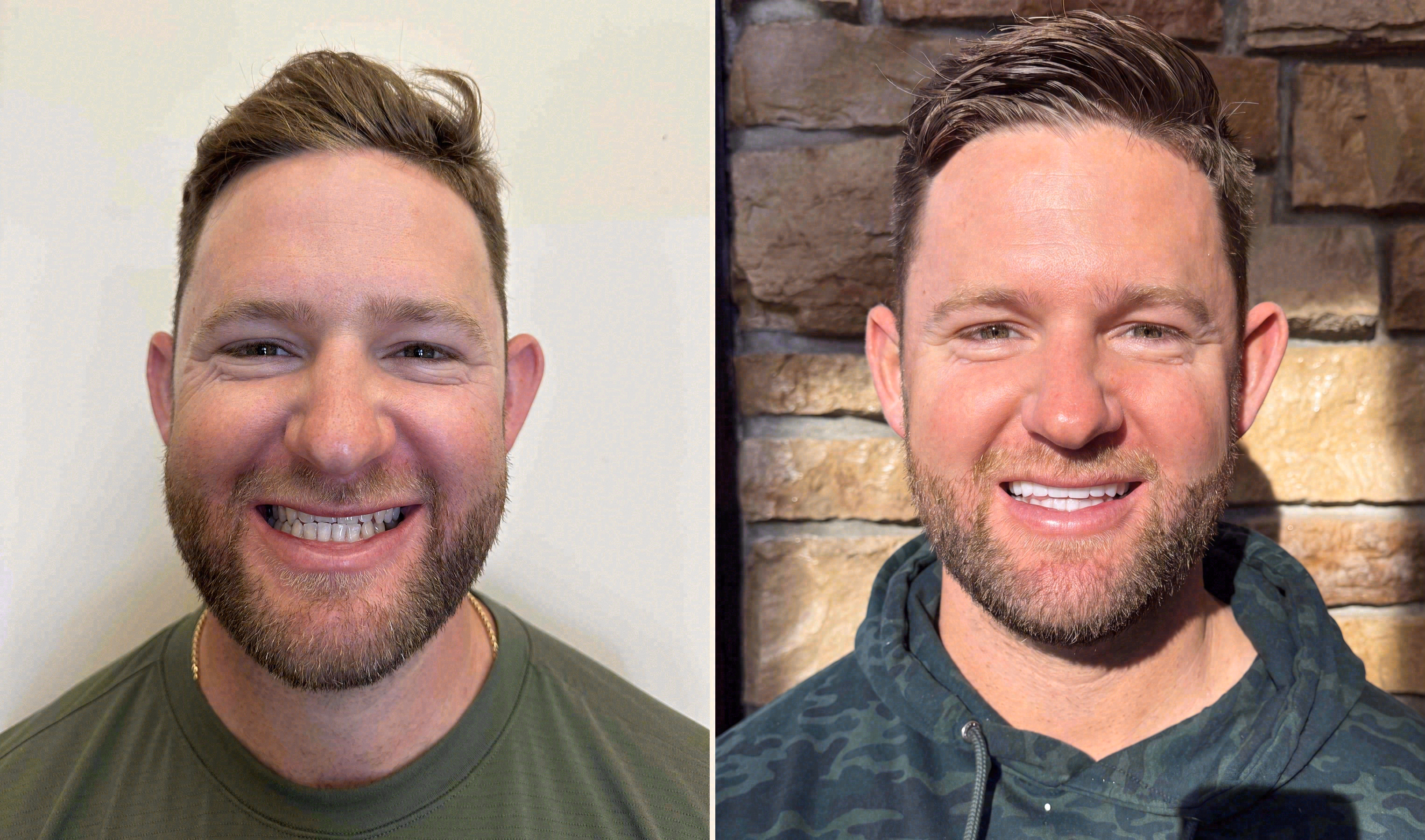 Before and after: porcelain veneers case at Sola Dental Spa