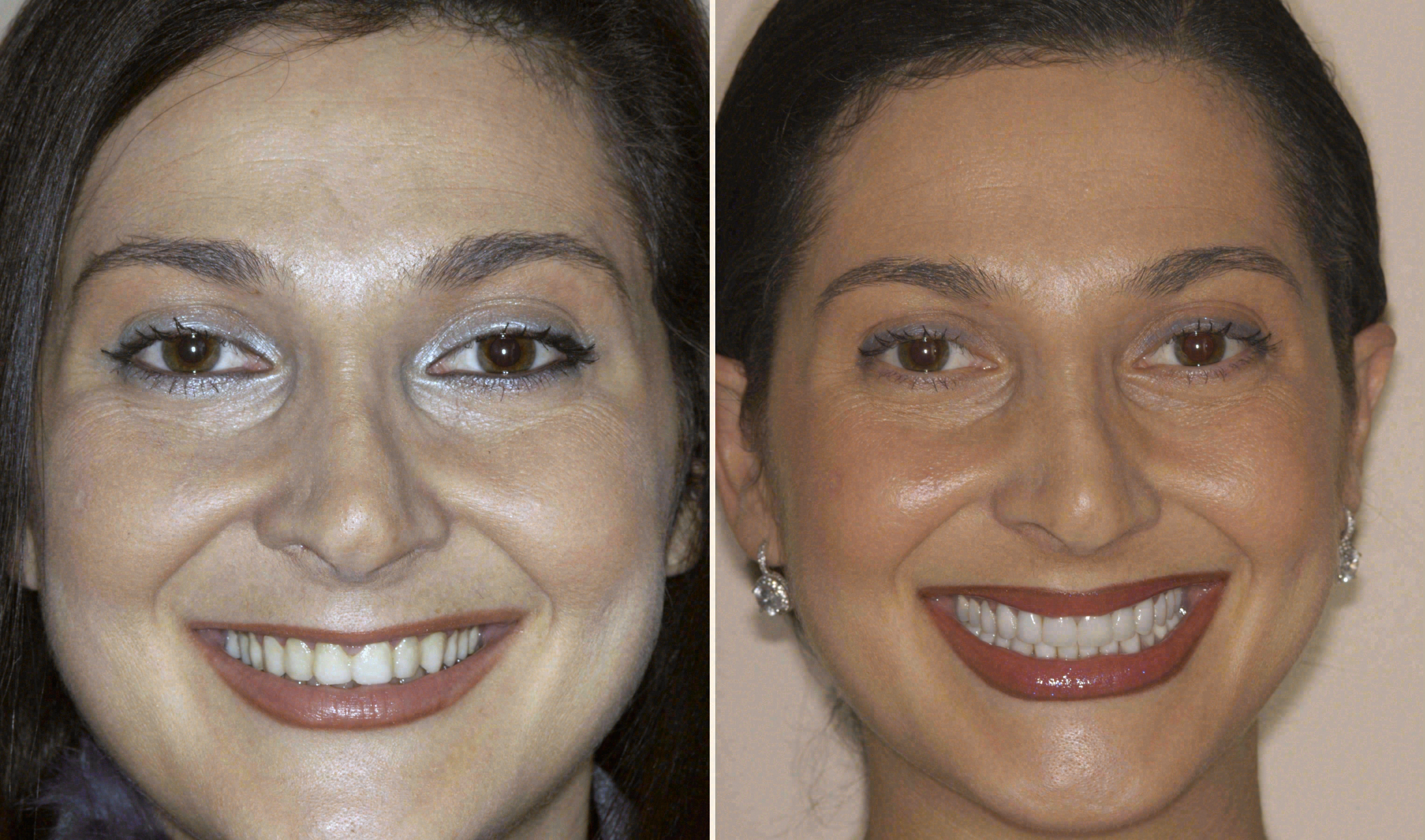 Before and after: porcelain veneers case at Sola Dental Spa