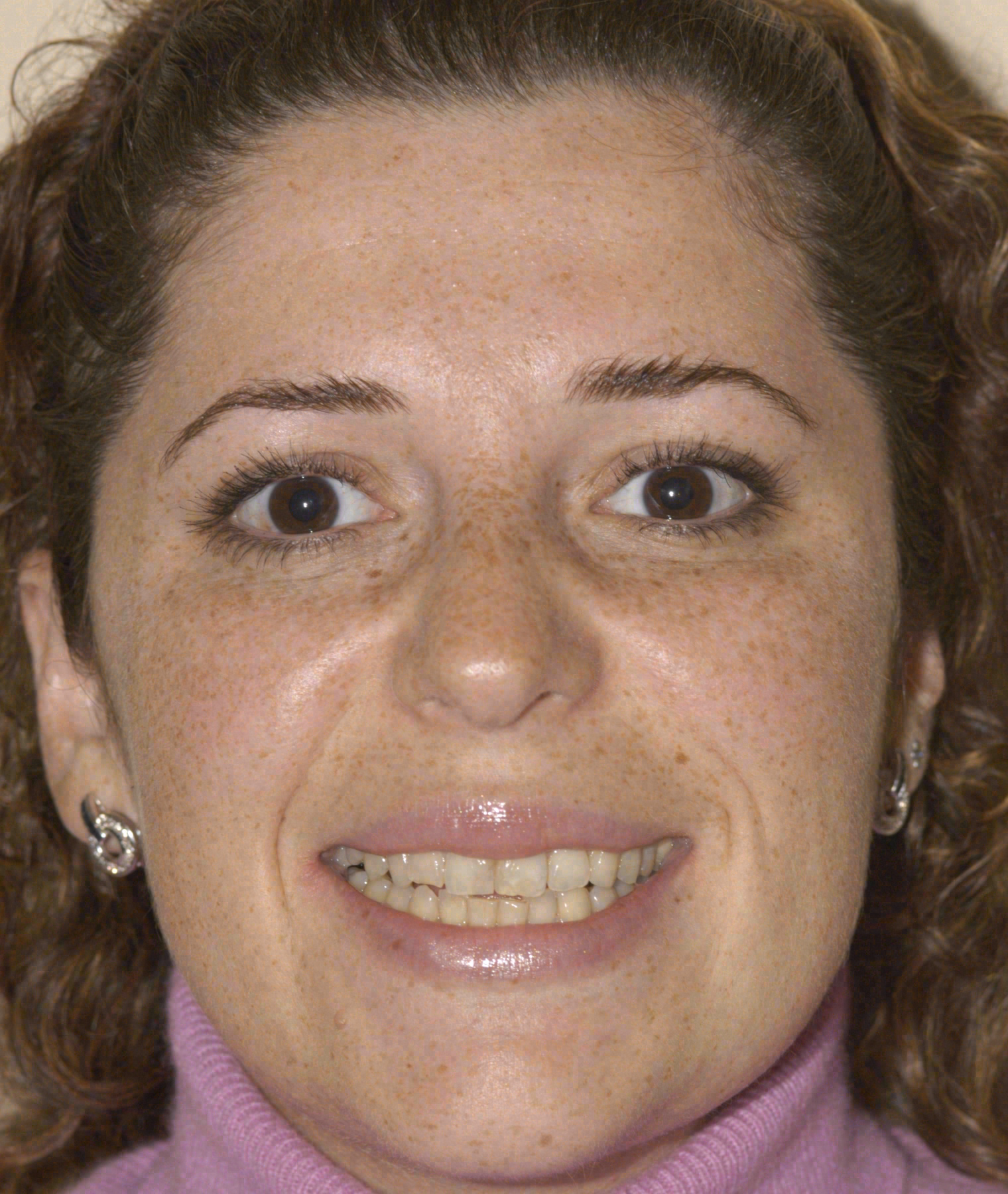 Before porcelain veneers at Sola Dental Spa