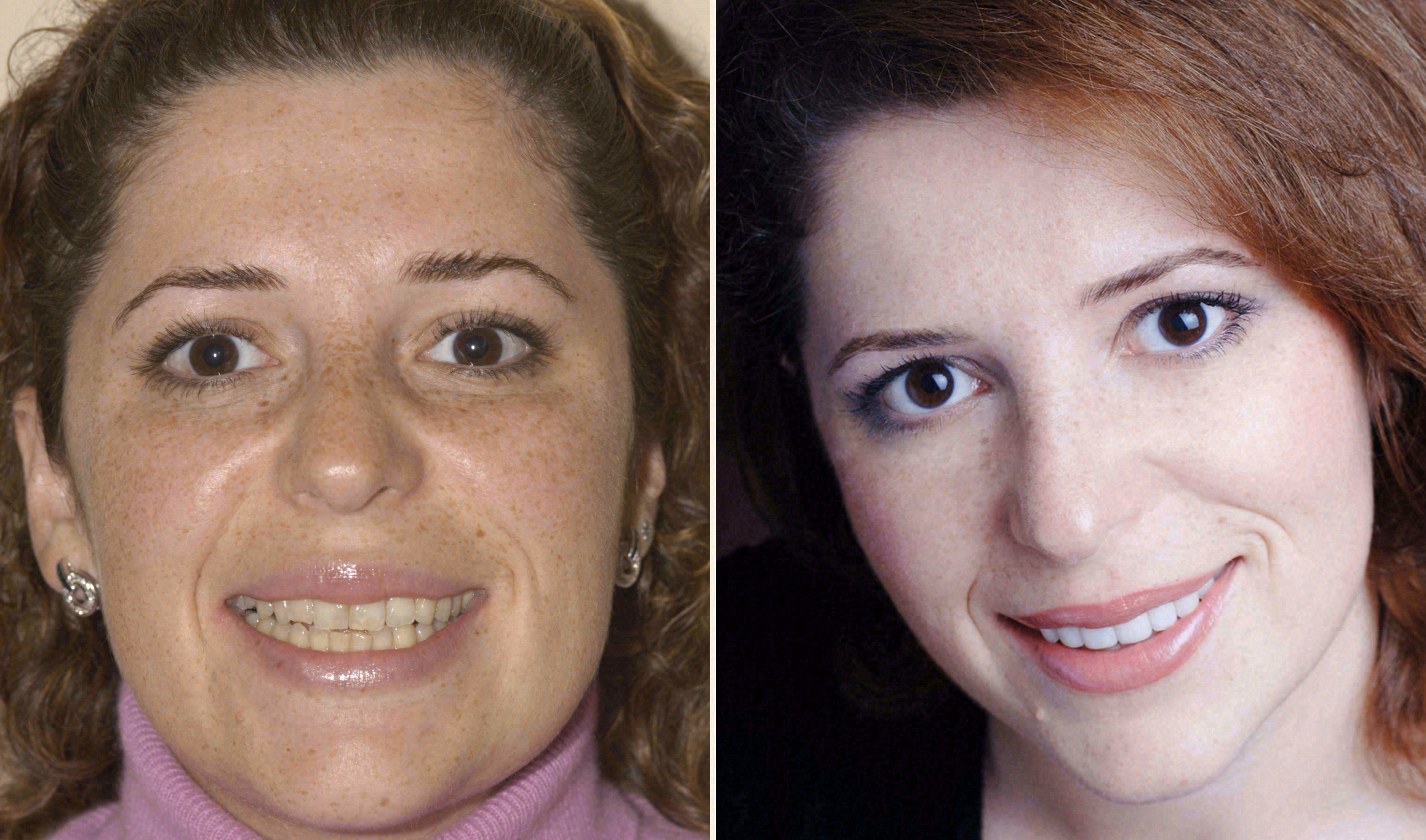 Before and after: porcelain veneers case at Sola Dental Spa
