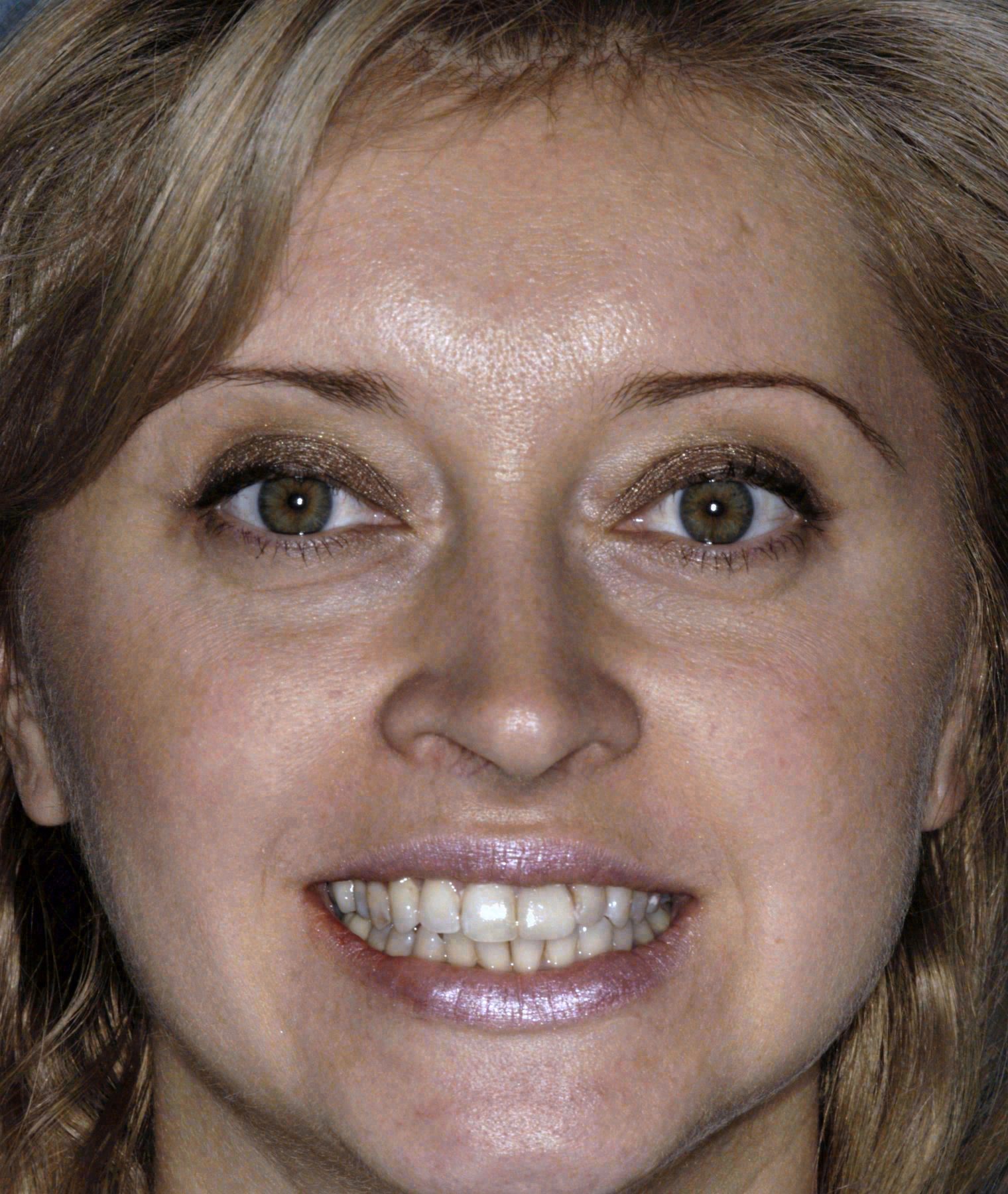 Before porcelain veneers at Sola Dental Spa