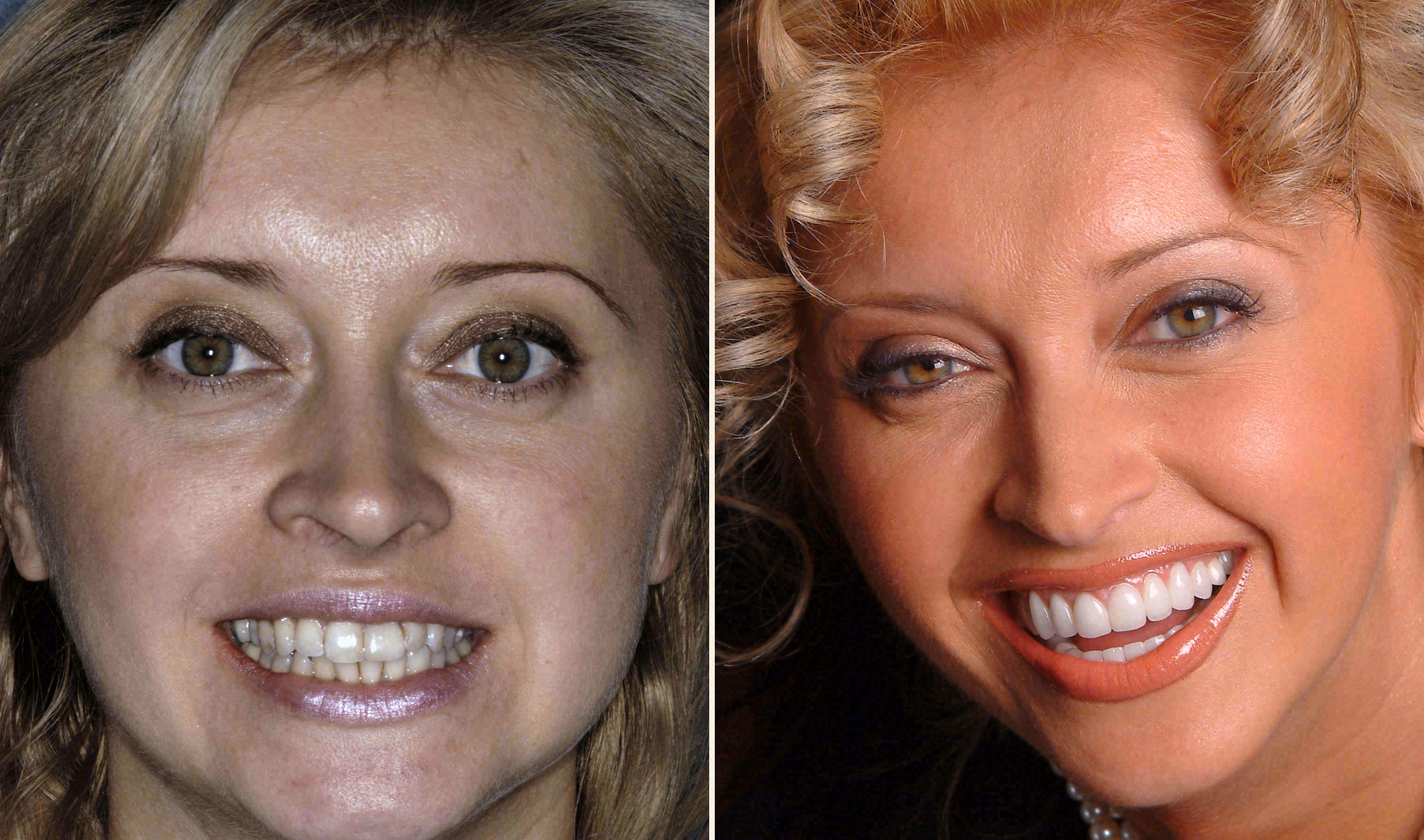 Before and after: porcelain veneers case at Sola Dental Spa