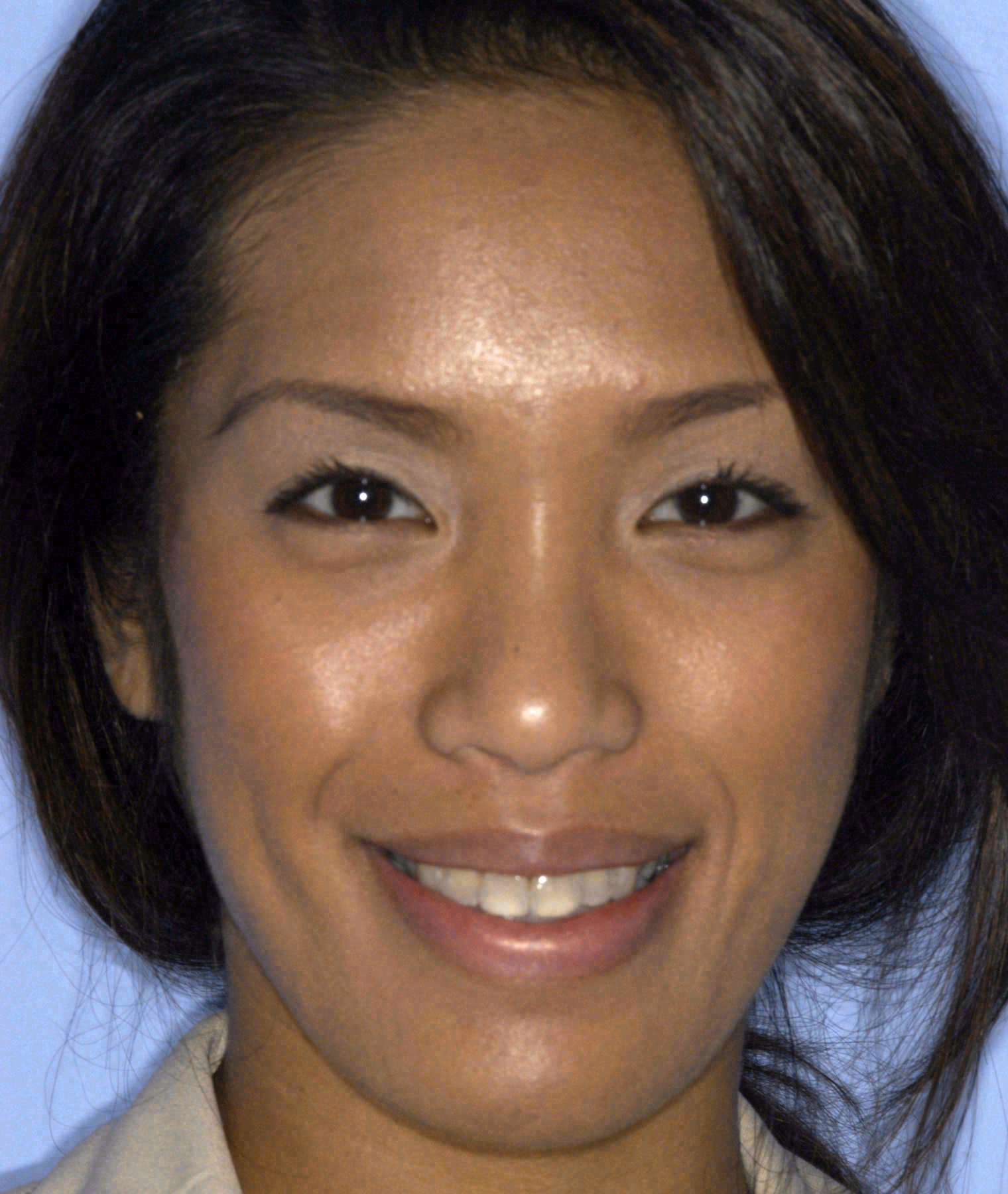 Before porcelain veneers and crowns at Sola Dental Spa