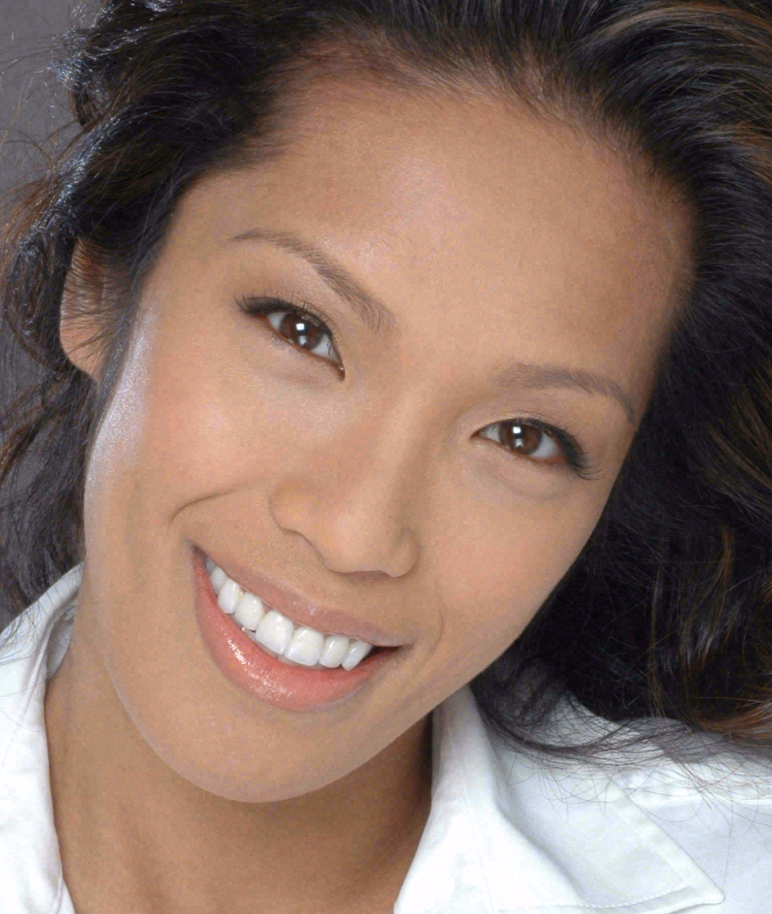 After porcelain veneers and crowns at Sola Dental Spa