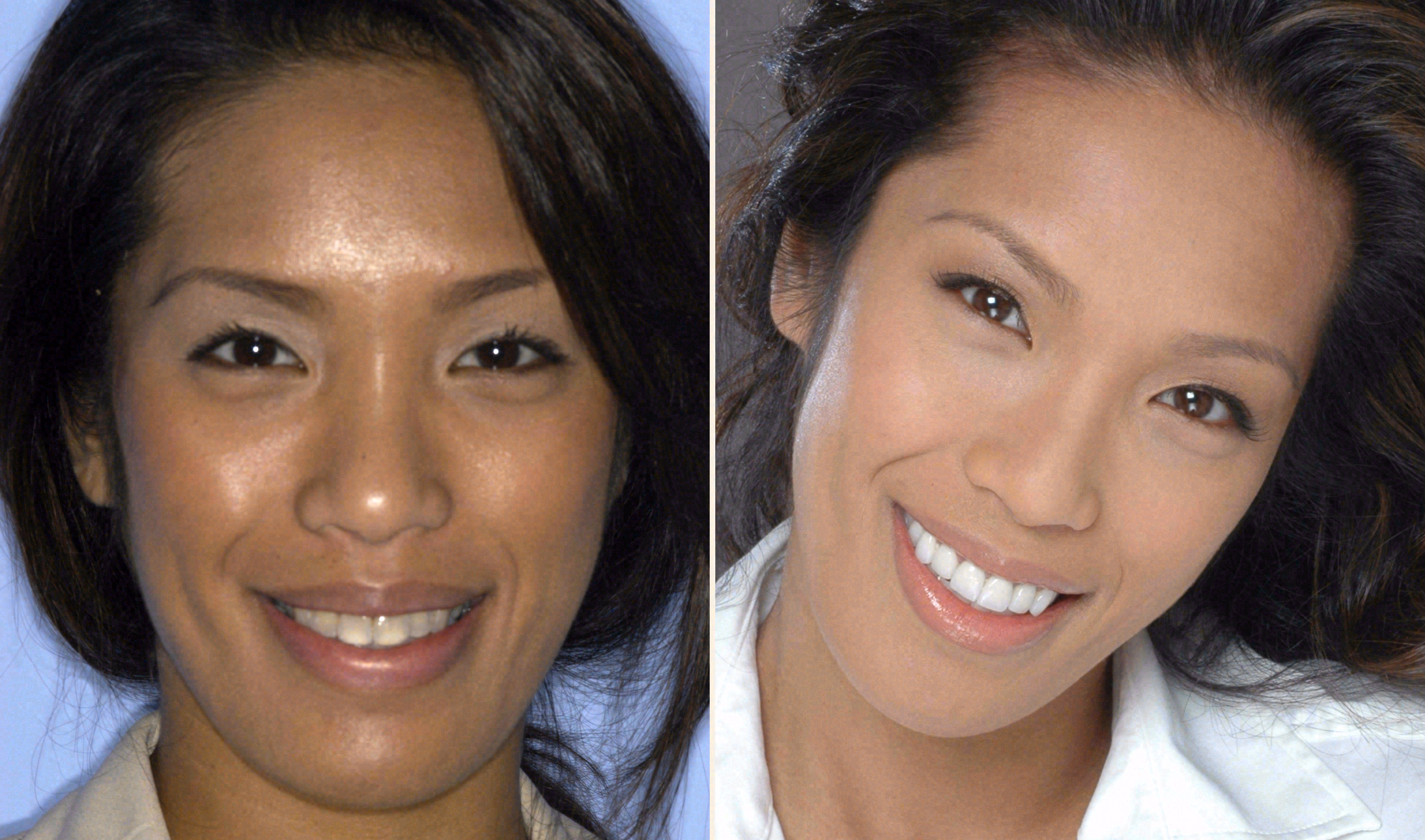 Before and after: porcelain veneers and crowns case at Sola Dental Spa