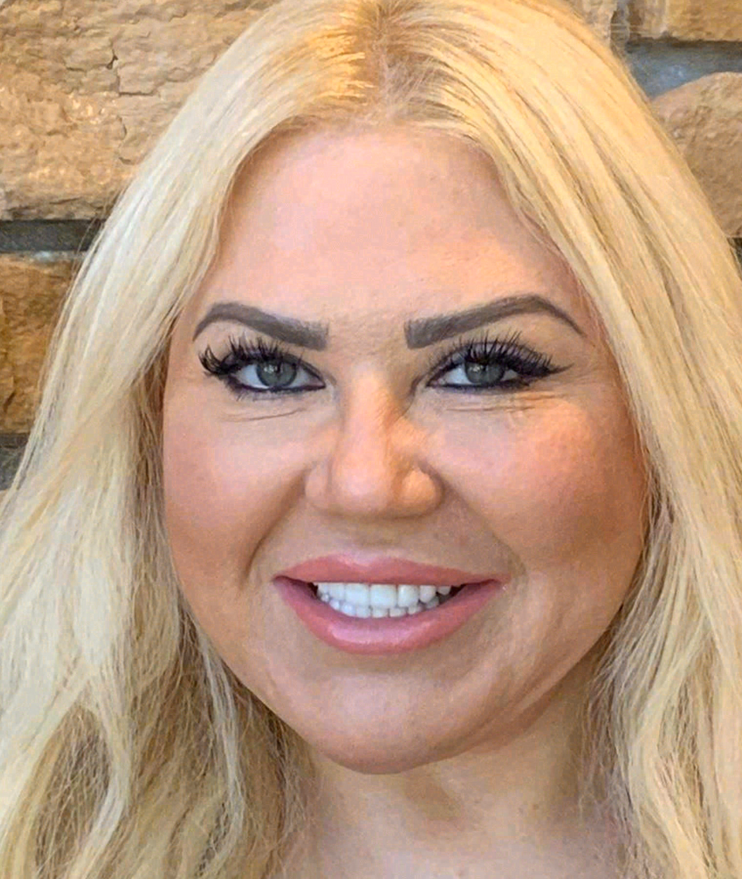 After porcelain veneers at Sola Dental Spa