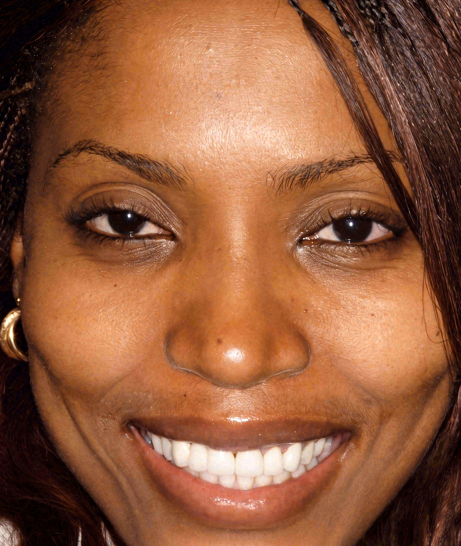 After porcelain veneers at Sola Dental Spa