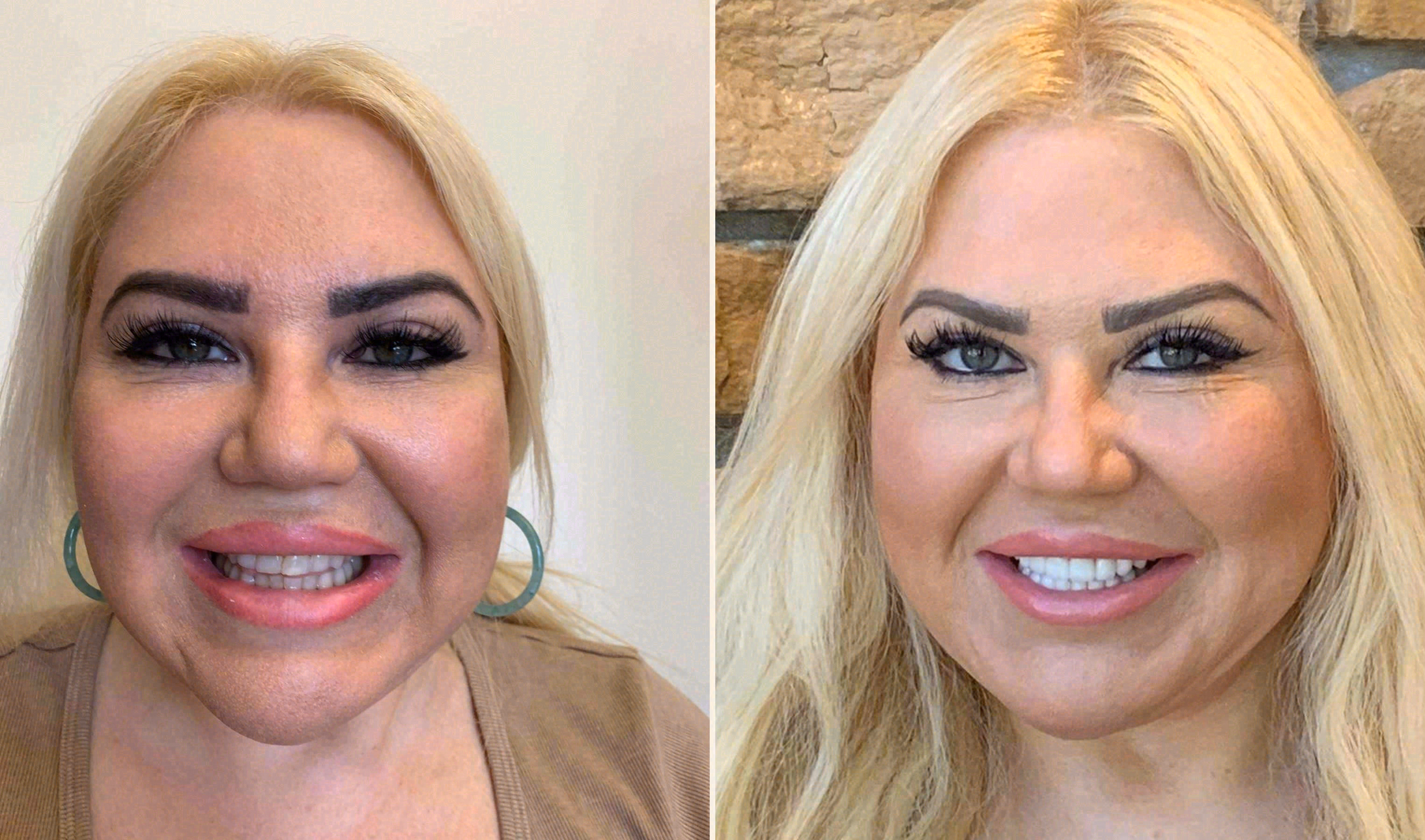 Before and after: porcelain veneers case at Sola Dental Spa