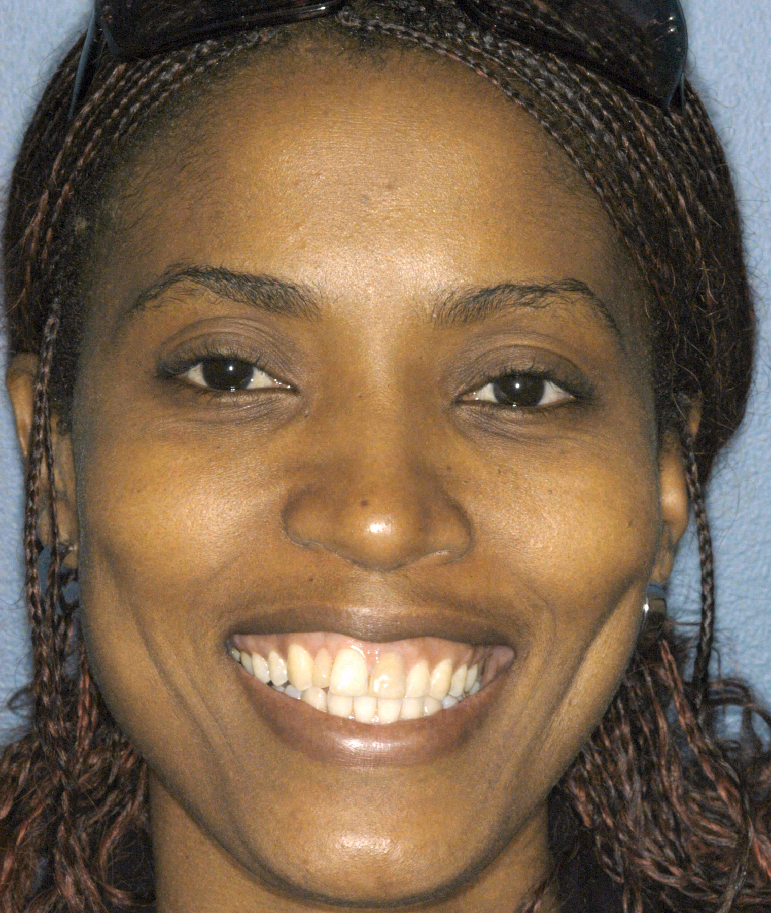 Before porcelain veneers at Sola Dental Spa