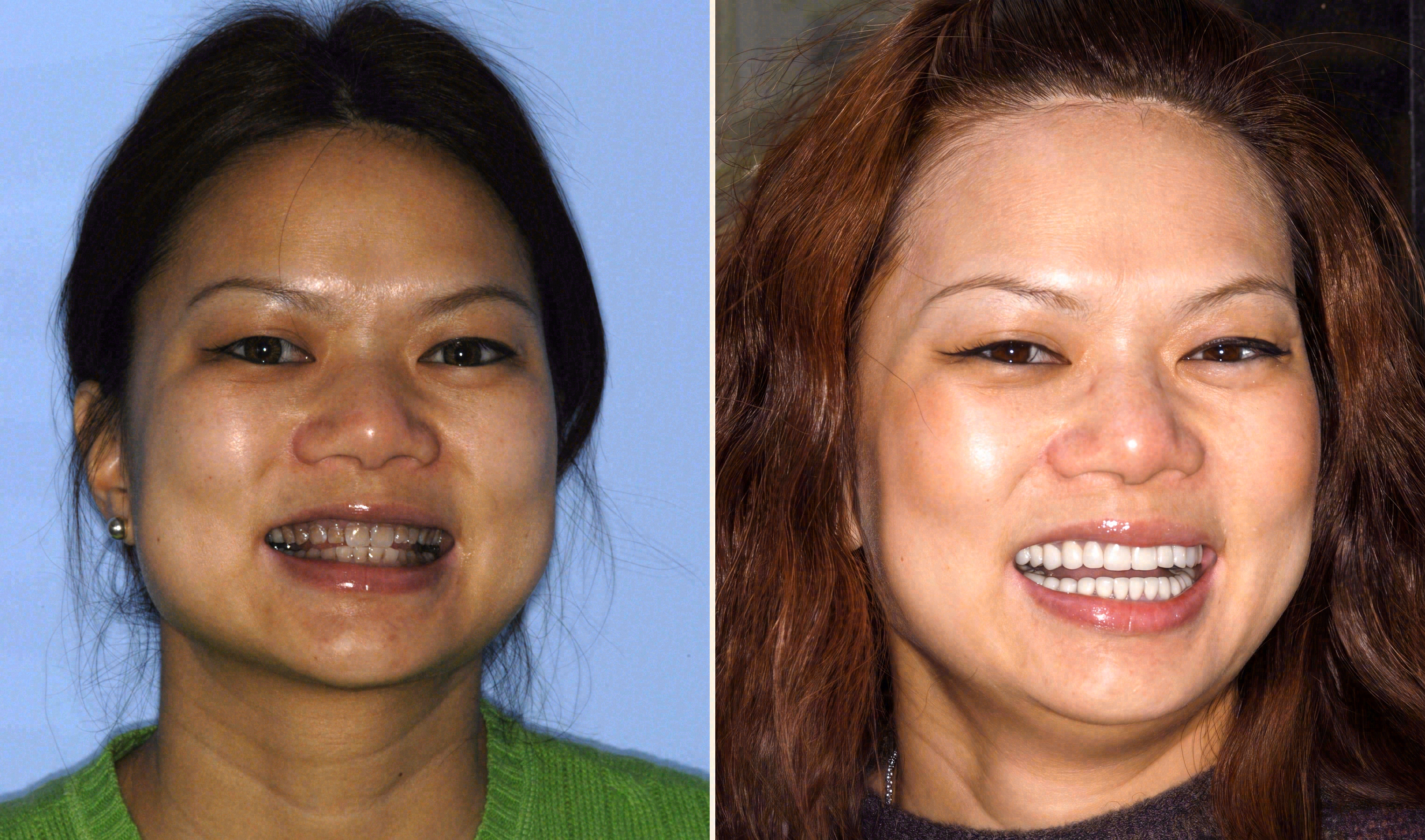 Before and after: porcelain veneers case at Sola Dental Spa