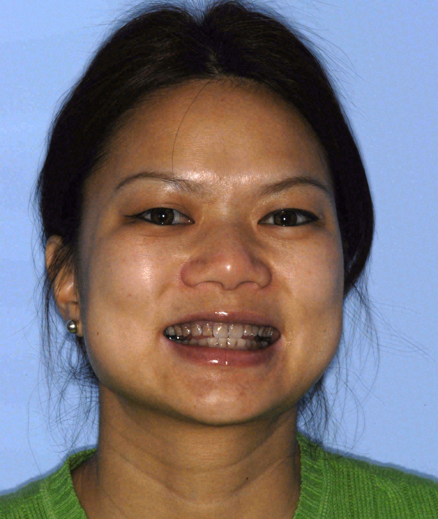 Before porcelain veneers at Sola Dental Spa