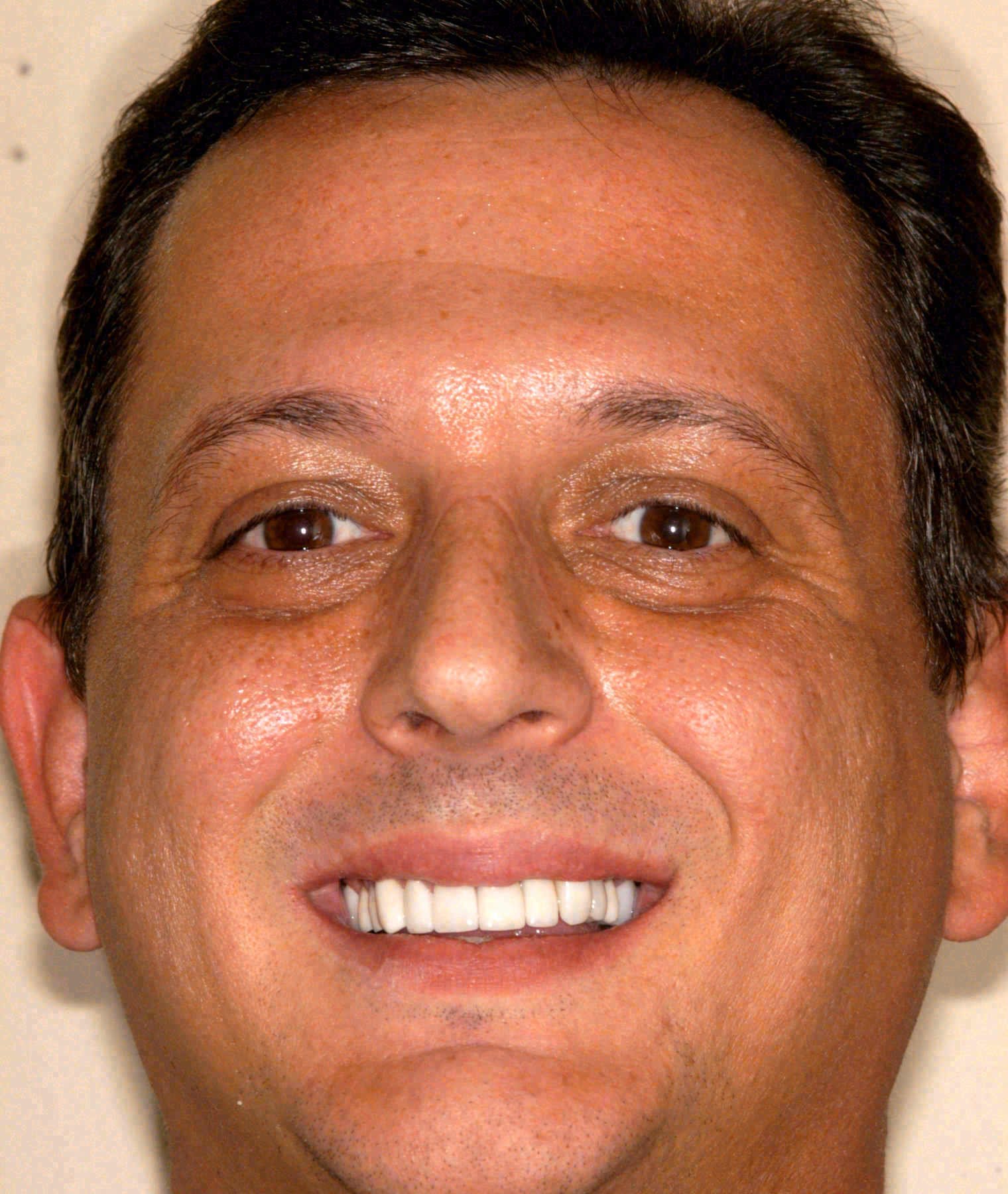 After porcelain veneers at Sola Dental Spa