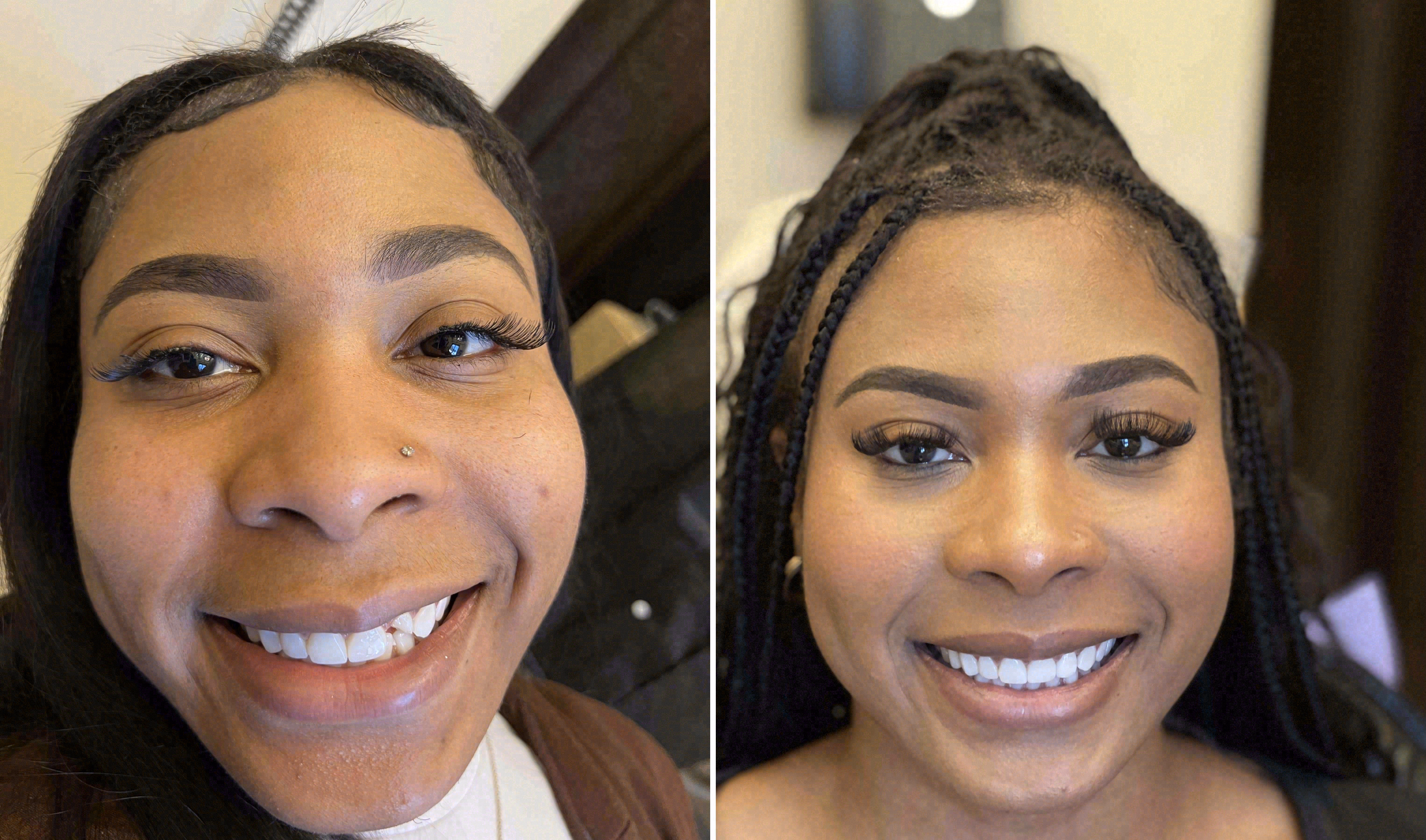 Before and after: porcelain veneers case at Sola Dental Spa