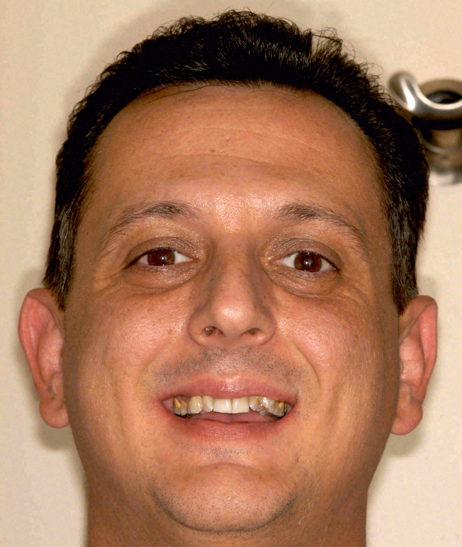 Before porcelain veneers at Sola Dental Spa