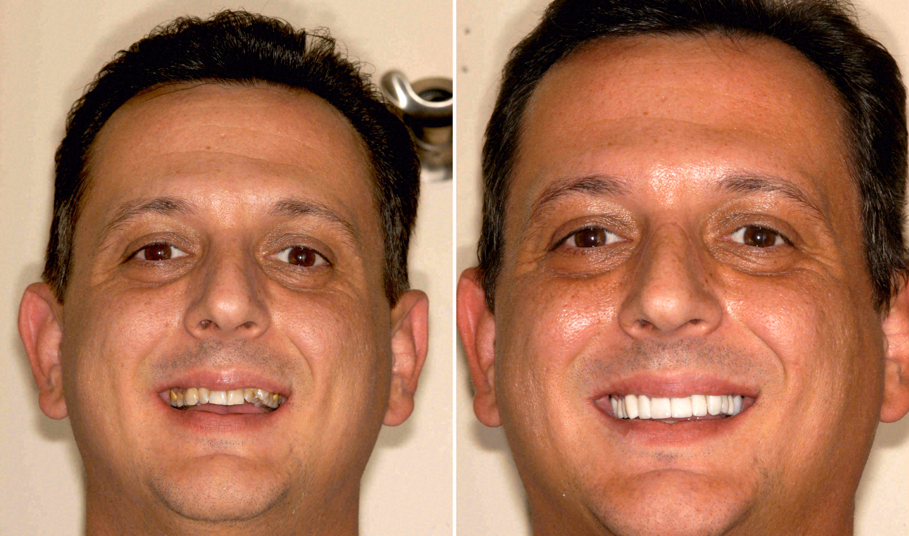 Before and after: porcelain veneers case at Sola Dental Spa